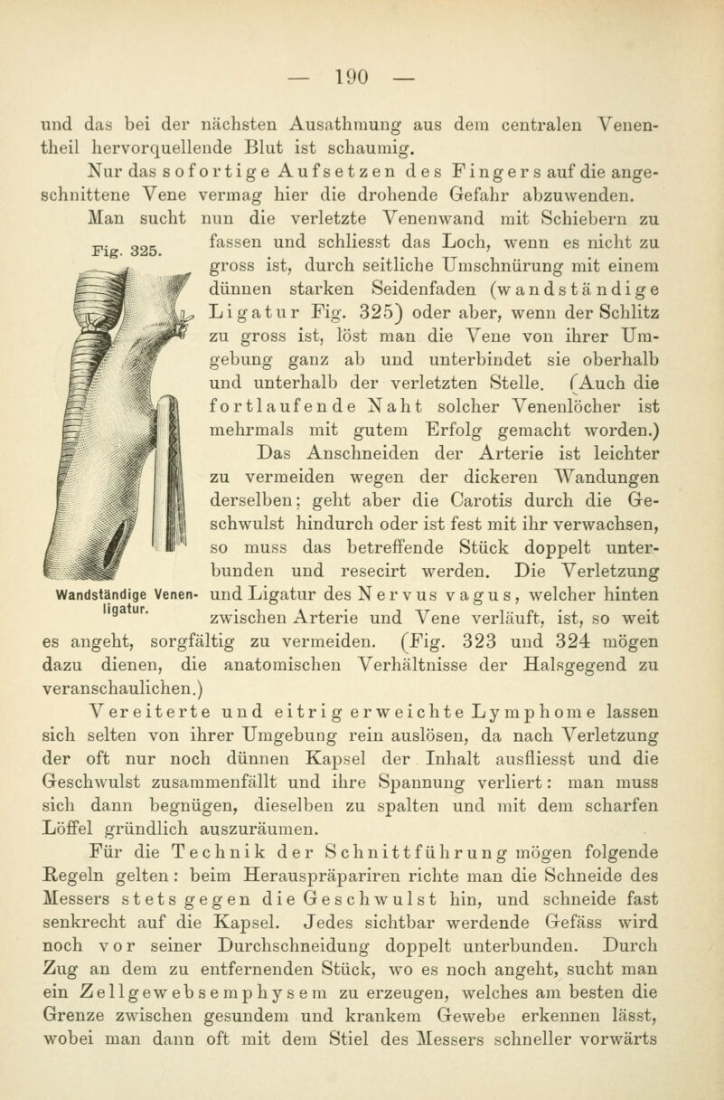 Man sucht Fig. 325. und das bei der nächsten Ausathraung aus dem centralen Venen- theil hervorquellende Blut ist schaumig. Nur das sofortige Aufsetzen des Fingers auf die ange- schnittene Vene vermag hier die drohende Gefahr abzuwenden. nun die verletzte Venenwand mit Schiebern zu fassen und schliesst das Loch, wenn es nicht zu gross ist, durch seitliche Umschnürung mit einem dünnen starken Seidenfaden (wandständige Ligatur Fig. 325} oder aber, wenn der Schlitz zu gross ist, löst man die Vene von ihrer Um- gebung ganz ab und unterbindet sie oberhalb und unterhalb der verletzten Stelle. (Auch die fortlaufende Naht solcher Venenlöcher ist mehrmals mit gutem Erfolg gemacht worden.) Das Anschneiden der Arterie ist leichter zu vermeiden wegen der dickeren Wandungen derselben; geht aber die Carotis durch die Gre- schwulst hindurch oder ist fest mit ihr verwachsen, so muss das betreffende Stück doppelt unter- bunden und resecirt werden. Die Verletzung und Ligatur des Nervus vagus, welcher hinten zwischen Arterie und Vene verläuft, ist, so weit es angeht, sorgfältig zu vermeiden. (Fig. 323 und 324 mögen dazu dienen, die anatomischen Verhältnisse der Halsgegend zu veranschaulichen.) Vereiterte und eitr i g er weicht e Lymp hom e lassen sich selten von ihrer Umgebung rein auslösen, da nach Verletzung der oft nur noch dünnen Kapsel der Inhalt ausfiiesst und die Geschwulst zusammenfällt und ihre Spannung verliert: man muss sich dann begnügen, dieselben zu spalten und mit dem scharfen Löffel gründlich auszuräumen. Für die Technik der S chnittführung mögen folgende Regeln gelten: beim Herauspräpariren richte man die Schneide des Messers stets gegen die Geschwulst hin, und schneide fast senkrecht auf die Kapsel. Jedes sichtbar werdende Gefäss wird noch vor seiner Durchschneidung doppelt unterbunden. Durch Zug an dem zu entfernenden Stück, wo es noch angeht, sucht man ein Zellgewebsemphysem zu erzeugen, welches am besten die Grenze zwischen gesundem und krankem Gewebe erkennen lässt, wobei man dann oft mit dem Stiel des Messers schneller vorwärts Wandständige Venen- ligatur.