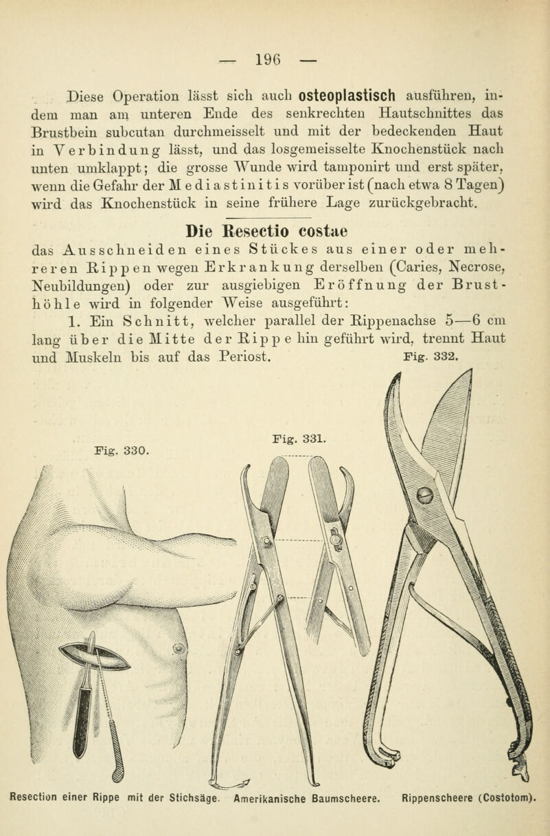 Diese Operation lässt sich aucb osteoplastisch ausführen, in- dem man am unteren Ende des senkrechten Hautschnittes das Brustbein subcutan durchmeisselt und mit der bedeckenden Haut in Verbindung lässt, und das losgemeisselte Knochenstück nach unten umklappt; die grosse Wunde wird tamponirt und erst später, wenn die Gefahr der Mediastinitis vorüber ist (nach etwa 8 Tagen) wird das Knochenstück in seine frühere Lage zurückgebracht. Die ßesectio costae das Ausschneiden eines Stückes aus einer oder meh- reren E-ippen wegen Erkrankung derselben (Caries, Necrose, Neubildungen) oder zur ausgiebigen Eröffnung der Brust- höhle wird in folgender Weise ausgeführt: 1. Ein Schnitt, welcher parallel der Bippenachse 5—6 cm lang über die Mitte derBippe hin geführt wird, trennt Haut und Muskeln bis auf das Periost. Fig. 332. Fig. 330. Resection einer Rippe mit der Stichsäge. Amerikanische Baumscheere. Rippenscheere (Costotom).