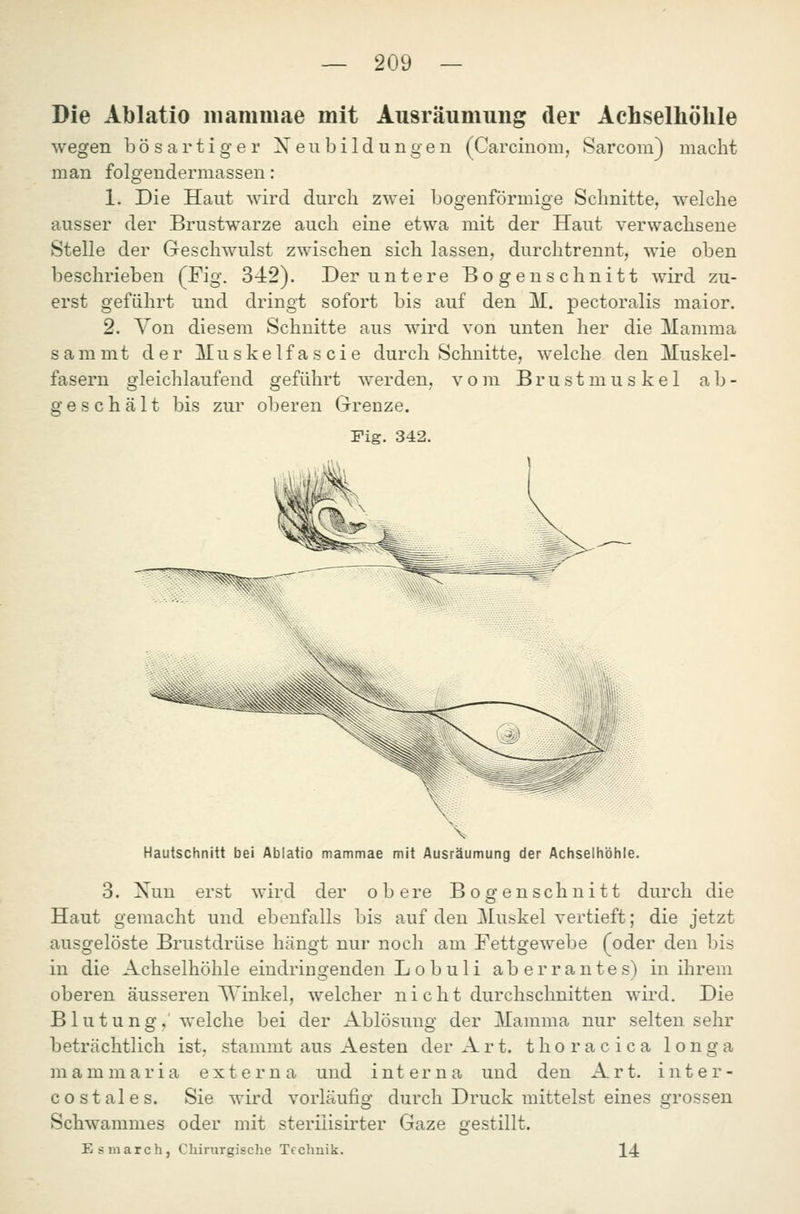 Die Ablatio mammae mit Ausräumung der Achselhölile wegen bösartiger X eiibildungeu (Carcinom, Sarcoin) macht man folgendermassen: 1. Die Haut wird durch zwei bogenförmige Schnitte, welche ausser der Brustwarze auch eine etwa mit der Haut verwachsene Stelle der Geschwulst zwischen sich lassen, durchtrennt, wie oben beschrieben (Fig. 342). Der untere Bogenschnitt wird zu- erst geführt und dringt sofort bis auf den M. pectoralis maior. 2. Von diesem Schnitte aus wird von unten her die Mamma s a m mt der Mu s k e 1 f a s c i e durch Schnitte, welche den Muskel- fasern gleichlaufend geführt werden, vom Brustmuskel ab- geschält bis zur oberen Grenze. Fig. 342. -äSi^ Hautschnitt bei Ablatio mammae mit Ausräumung der Achseliiöhle. 3. Nun erst wird der obere Bogenschnitt durch die Haut gemacht und ebenfalls bis auf den Muskel vertieft; die jetzt ausgelöste Brustdrüse hängt nur noch am Fettgewebe (oder den bis in die Achselhöhle eindringenden L o b u 1 i aberrautes) in ihrem oberen äusseren Winkel, welcher n i c h t durchschnitten wird. Die B lutung,' welche bei der Ablösung der Mamma nur seitensehr beträchtlich ist, stammt aus Aesten der Art. thoracica longa m a m m a r i a externa und interna und den Art. i n t e r - CO st al es. Sie wird vorläufig durch Druck mittelst eines grossen Schwammes oder mit steriiisirter Gaze gestillt. Esniarch, Chirurgische Technik. 14