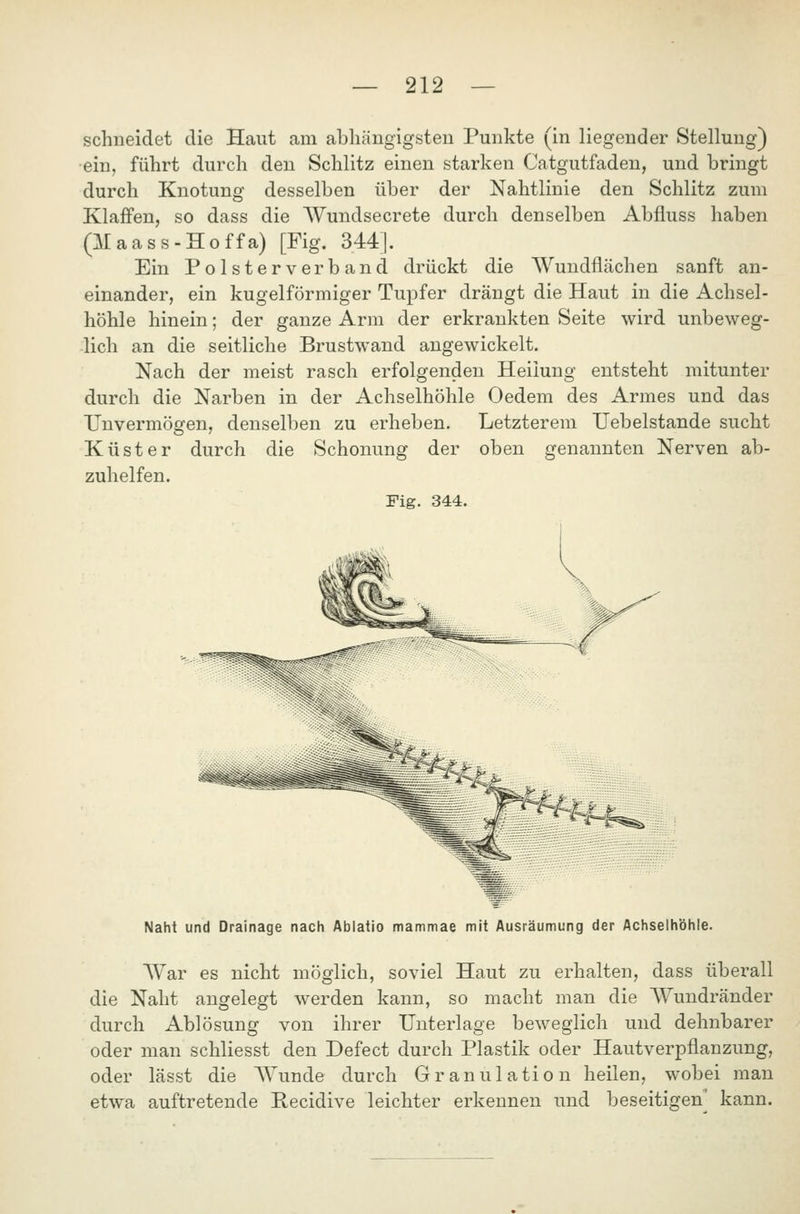 schneidet die Haut am abhängigsten Punkte (in liegender Stellung) ein, führt durch den Schlitz einen starken Catgutfaden, und bringt durch Knotung desselben über der Nahtlinie den Schlitz zum Klaffen, so dass die Wundsecrete durch denselben Abfluss haben (Maass-Hoffa) [Fig. 344]. Ein Polsterverband drückt die Wundflächen sanft an- einander, ein kugelförmiger Tupfer drängt die Haut in die Achsel- höhle hinein; der ganze Arm der erkrankten Seite wird unbeweg- lich an die seitliche Brustwand angewickelt. Nach der meist rasch erfolgenden Heilung entsteht mitunter durch die Narben in der Achselhöhle Oedem des Armes und das Unvermögen, denselben zu erheben. Letzterem Uebelstande sucht Küster durch die Schonung der oben genannten Nerven ab- zuhelfen. Fig. 344. ^ti Naht und Drainage nach Ablatio mammae mit Ausräumung der Achselhöhle. War es nicht möglich, soviel Haut zu erhalten, dass überall die Naht angelegt werden kann, so macht man die Wundränder durch Ablösung von ihrer Unterlage beweglich und dehnbarer oder man schliesst den Defect durch Plastik oder Hautverpflanzung, oder lässt die Wunde durch Granulation heilen, wobei man etwa auftretende Recidive leichter erkennen und beseitigen kann.