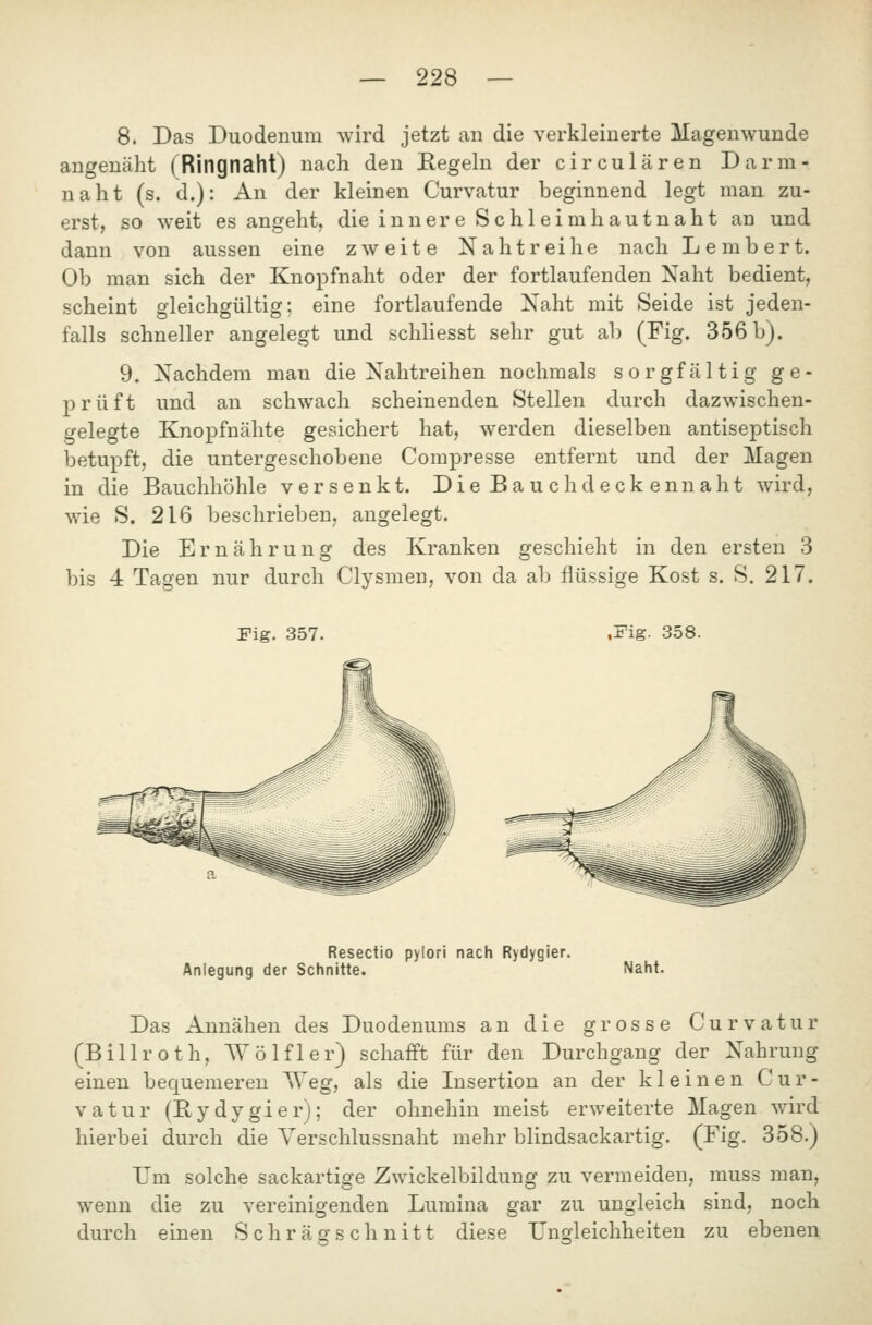 8. Das Duodenum wird jetzt an die verkleinerte Magenwunde angenäht (Ringnaht) nach den Kegeln der circulären Darm- naht (s. d.): An der kleinen Curvatur beginnend legt man zu- erst, so weit es angeht, die innere Schleimhautnaht an und dann von aussen eine zweite Nahtreihe nach Lembert. Ob man sich der Knopfnaht oder der fortlaufenden Naht bedient, scheint gleichgültig; eine fortlaufende Naht mit Seide ist jeden- falls schneller angelegt und schliesst sehr gut ab (Fig. 356 b). 9. Nachdem man die Nahtreihen nochmals sorgfältig ge- prüft und an schwach scheinenden Stellen durch dazwischen- gelegte Knopfnähte gesichert hat, werden dieselben antiseptisch betupft, die untergeschobene Compresse entfernt und der Magen in die Bauchhöhle versenkt. Die Bauch deckennaht wird, wie S. 216 beschrieben, angelegt. Die Ernährung des Kranken geschieht in den ersten 3 bis 4 Tagen nur durch Clysmen, von da ab flüssige Kost s. S. 217. Fig. 357. ,Fig. 358. Resectio pylori nach Rydygier. Anlegung der Schnitte. Naht. Das Annähen des Duodenums an die grosse Curvatur (Billroth, Wolf 1er) schafft für den Durchgang der Nahrung einen bequemeren Weg, als die Insertion an der kleinen Cur- vatur (Rydygier); der ohnehin meist erweiterte Magen wird hierbei durch die Yerschlussnaht mehr blindsackartig. (Fig. 358.) Um solche sackartige Zwickelbildung zu vermeiden, muss man, wenn die zu vereinigenden Lumina gar zu ungleich sind, noch durch einen Schräm schnitt diese TJn Weichheiten zu ebenen