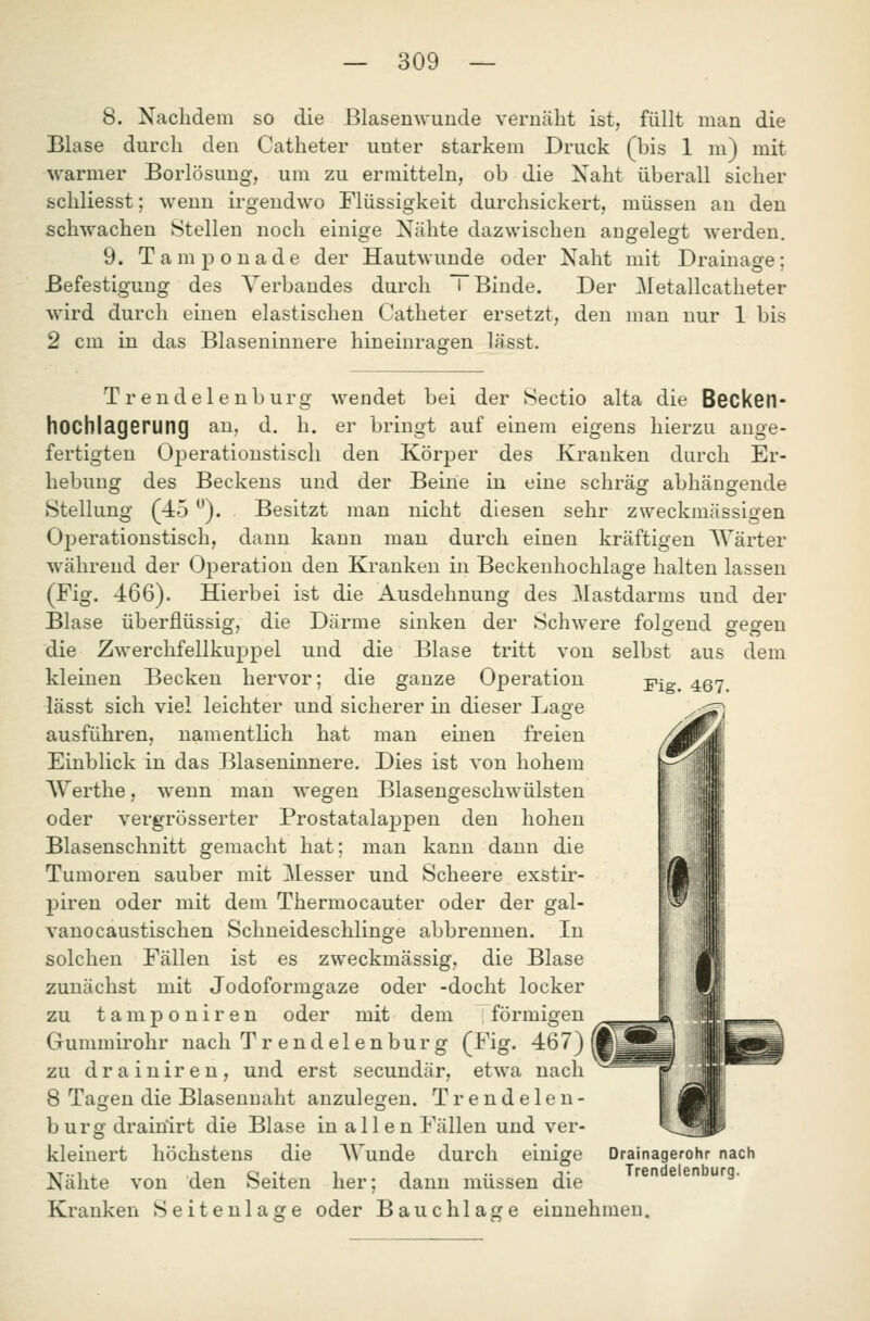 8. Nachdem so die Blasemvunde vernäht ist, füllt man die Blase durch den Catheter unter starkem Druck (bis 1 m) mit warmer Borlösung, um zu ermitteln, ob die Naht überall sicher schliesst; wenn irgendwo Flüssigkeit durchsickert, müssen an den schwachen Stellen noch einige Nähte dazwischen angelegt werden. 9. Tampouade der Hautwunde oder Naht mit Drainage; Befestigung des Verbandes durch T Binde. Der Metallcatheter wird durch einen elastischen Catheter ersetzt, den man nur 1 bis 2 cm in das Blaseninnere hineinragen lässt. wendet bei der Sectio alta die Becken- er bringt auf einem eigens hierzu auge- des Krauken durch Er- schräsr abhängende eine 'Trendelenburg hochlagerung an, d. h fertigten Operationstisch den Körper hebung des Beckens und der Beine in ^ ^^^.^^ ^ ^ Stellung (45 ). Besitzt man nicht diesen sehr zweckmässigen Operationstisch, dann kann man durch einen kräftigen Wärter während der Operation den Kranken in Beckenhochlage halten lassen (Fig. 466). Hierbei ist die Ausdehnung des Mastdarms und der Blase überflüssig, die Därme sinken der Schwere die Zwerchfellkuppel und die Blase tritt von kleinen Becken hervor; die ganze Operation lässt sich viel leichter und sicherer in dieser Lage ausführen, namentlich hat man einen freien Einblick in das Blaseninnere. Dies ist von hohem Werthe, wenn man wegen Blasengeschwülsten oder vergrösserter Prostatalappen den hohen Blasenschnitt gemacht hat; man kann dann die Tumoren sauber mit 3lesser und Scheere exstir- piren oder mit dem Thermocauter oder der gal- vanocaustischen Schneideschlinge abbrennen. In solchen Fällen ist es zweckmässig, die Blase zunächst mit Jodoformgaze oder -docht locker zu t a m p 0 n i r e n oder mit dem ; förmigen Gummirohr nach Tr endel enbur g (Fig. 467) zu drainiren, und erst secundär, etwa nach 8 Tagen die Blasennaht anzulegen. T r e n d e 1 e n - bürg drainirt die Blase in allen Fällen und ver- kleinert höchstens die Wunde durch einige Nähte von den Seiten her; dann müssen die Kranken Seitenlage oder Bauchlage einnehmen. folofend ffeofen aus selbst Fig. 467. dem Drainagerohr nach Trendelenburg.