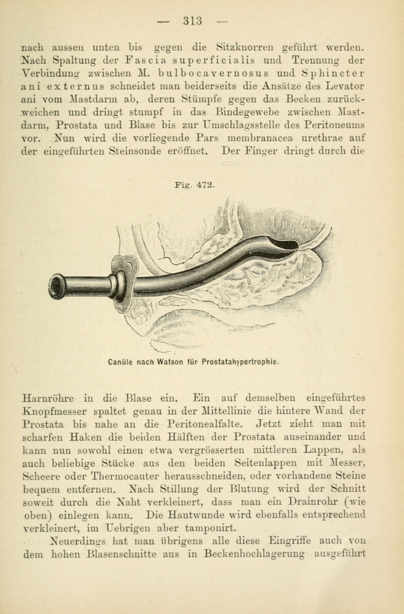 Dacli aussen unteu bis gegen die Sitzknorren geführt werden. Nach Spaltung der Fascia superficialis und Trennung der Verbindung zwischen M. bulbo cavernosus und Sp hin et er ani externus schneidet man beiderseits die Ansätze des Levator ani vom Mastdarm ab, deren Stümpfe gegen das Becken zurück- .weichen und dringt stumpf in das Bindegewebe zwischen Mast- darm, Prostata und Blase bis zur Umschlagsstelle des Peritoneums vor. Xun wird die vorliegende Pars membranacea urethrae auf der eingeführten Steinsonde eröffnet. Der Finger dringt durch die Fig. 472. Canüle nach Watson für Prostatahypertrophie. Harnröhre in die Blase ein. Ein auf demselben eingeführtes Knopfmesser spaltet genau in der Mittellinie die hintere AVand der Prostata bis nahe an die Peritonealfalte. Jetzt zieht man mit scharfen Haken die beiden Hälften der Prostata auseinander und kann nun sowohl einen etwa vergrösserten mittleren Lappen, als auch beliebige Stücke aus den beiden Seitenlappen mit Messer, Scheere oder Thermocauter herausschneiden, oder vorhandene Steine bequem entfernen. Nach Stillung der Blutung wird der Schnitt soweit durch die Xaht verkleinert, dass man ein Drainrohr (wie oben) einlegen kann. Die Hautwunde wird ebenfalls entsprechend verkleinert, im TJebrigen aber tamponirt. Neuerdings hat man übrigens alle diese Eingriffe auch von dem hohen Blasenschnitte aus in Beckenhochlagerung ausgeführt