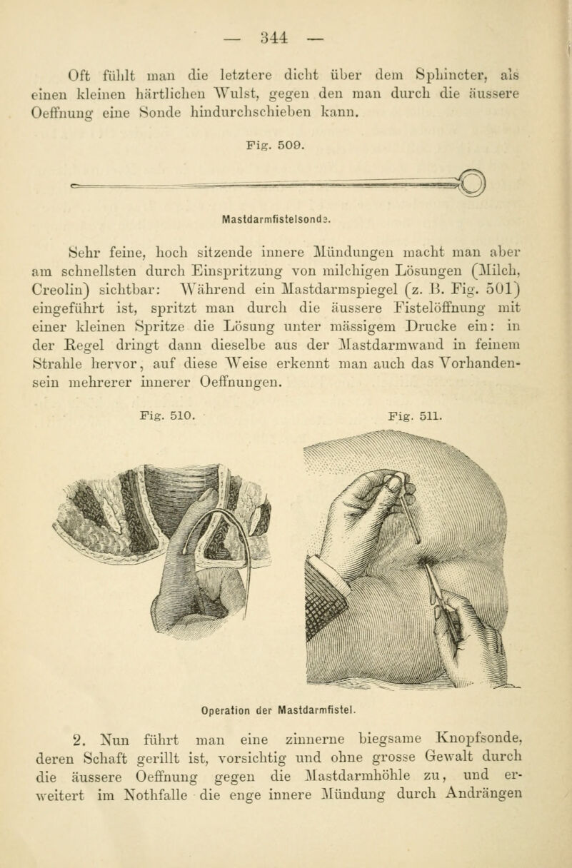 Oft fülilt man die letztere dicht über dem SpLincter, als einen kleineu härtlichen AV^ulst, gegen den man durch die äussere Oeffnuno: eine Sonde hindurchschieben kann. Fig. 509. Mastdarmfistelsonda. Sehr feine, hoch sitzende innere Mündungen macht man aber am schnellsten durch Einspritzung von milchigen Lösungen (!Milch, Creolin) sichtbar: Während ein Mastdarmspiegel (z. B. Fig. 501) eingeführt ist, spritzt man durch die äussere Fistelöffnung mit einer kleinen Spritze die Lösung unter massigem Drucke ein: in der Regel dringt dann dieselbe aus der Mastdarmwand in feinem Strahle hervor, auf diese Weise erkennt man auch das Vorhanden- sein mehrerer innerer Oeffnungen. Fig. 510. Operation der Mastdarmfistel. 2. Nun führt man eine zinnerne biegsame Knopfsonde, deren Schaft gerillt ist, vorsichtig und ohne grosse Gewalt durch die äussere Oeffnung gegen die ]\[astdarmhöhle zu, und er- weitert im Nothfalle die enge innere ]\[ündung durch Andrängen