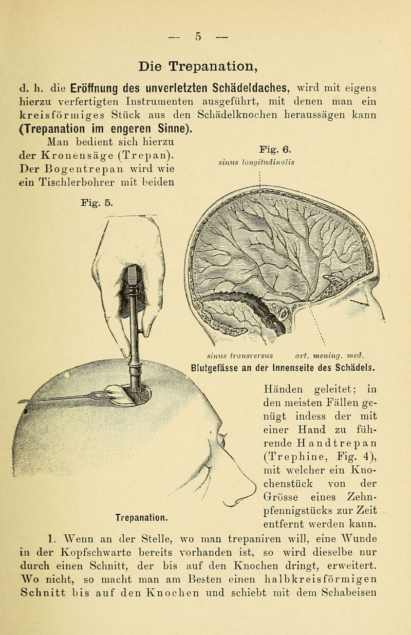Die Trepanation, d. h. die Eröffnung des unverletzten Schädeldaches, wird mit eigens hierzu verfertigten Instrumenten ausgeführt, mit denen man ein kreisförmiges Stück aus den Scliädelknochen heraussägen kann (Trepanation im engeren Sinne). Man bedient sich hierzu der Krouensäge (Trepan). _- _^ ^ . , ; simis longitiidinalis Der üogentrepan wird wie ein Tischlerbohrer mit beiden Trepanation. ari. mening. med. Blutgefässe an der Innenseite des Scliädels. Händen geleitet; in den meisten Fällen ge- nügt indess der mit einer Hand zu füh- rende Handtrepan (Trephine, Fig. 4), mit welcher ein Kno- chenstück von der Grösse eines Zehn- pfennigstücks zur Zeit entfernt werden kann. 1. Wenn an der Stelle, wo man trepaniren will, eine Wunde in der Kopfschwarte bereits vorhanden ist, so wird dieselbe nur durch einen Schnitt, der bis auf den Knochen dringt, erweitert. AVo nicht, so macht man am Besten einen halbkreisförmigen Schnitt bis auf den Knochen und schiebt mit dem Schabeisen