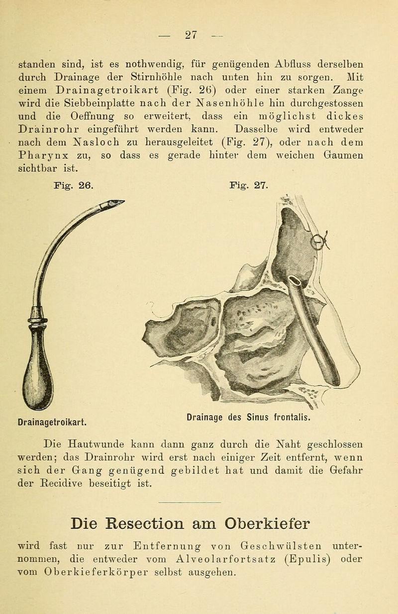 standen sind, ist es nothwendig, für genügenden Abfluss derselben durch Drainage der Stirnhöhle nach unten hin zu sorgen. Mit einem Drainagetroikart (Fig. 26) oder einer starken Zange wird die Siebbeinplatte nach der Nasenhöhle hin durchgestossen und die Oeffnung so erweitert, dass ein möglichst dickes Dräinrohr eingeführt werden kann. Dasselbe wird entweder nach dem Nasloch zu herausgeleitet (Fig. 27), oder nach dem Pharynx zu, so dass es gerade hinter dem weichen Gaumen sichtbar ist. Fig. 26. Fig. 27. Drainagetroikart. Drainage des Sinus frontalis. Die Hautwunde kann dann ganz durch die Naht geschlossen werden; das Drainrohr wird erst nach einiger Zeit entfernt, wenn sich der Gang genügend gebildet hat und damit die Gefahr der Eecidive beseitigt ist. Die Resection am Oberkiefer wird fast cur zur Entfernung von Geschwülsten unter- nommen, die entweder vom Alveolarfortsatz (Epulis) oder vom Oberkieferkörper selbst ausgehen.