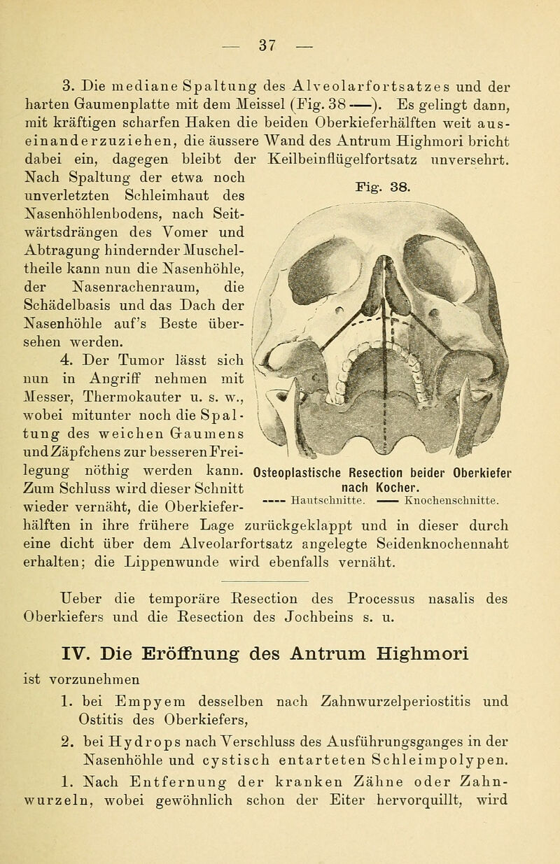 3. Die mediane Spaltung des Alveolarfortsatzes und der harten Gaumenplatte mit dem Meissel (Fig. 38 -—). Es gelingt dann, mit kräftigen scharfen Haken die beiden Oberkieferhälften weit aus- einanderzuziehen, die äussere AVand des Anti'um Highmori bricht dabei ein, dagegen bleibt der Keilbeinflügelfortsatz unversehrt. Nach Spaltung der etwa noch unverletzten Schleimhaut des Nasenhöhlenbodens, nach Seit- wärtsdrängen des Vomer und Abtragung hindernder IVIuschel- theile kann nun die Nasenhöhle, der Naseni'achenraum, die Schädelbasis und das Dach der Nasenhöhle auf's Beste über- sehen werden. 4. Der Tumor lässt sich { Fig. 38. nun in Angriif nehmen mit Messer, Thermokauter u. s. w., wobei mitunter noch die Spal- tung des weichen Gaumens undZäpfchens zur besserenFrei- legung nöthig werden kann. Zum Schluss wird dieser Schnitt wieder vernäht, die Oberkiefer- hälften in ihre frühere Lage zurückgeklappt und in dieser durch eine dicht über dem Alveolarfortsatz angelegte Seidenknochennaht erhalten; die Lippenwunde wird ebenfalls vernäht. Osteoplastische Resection beider Oberldefer nach Kocher. Haiitscliiütte. Knocheuschnitte. Ueber die temporäre ßesection des Processus nasalis des Oberkiefers und die Resection des Jochbeins s. u. IV. Die Eröffnung des Antrum Highmori ist vorzunehmen 1. bei Empyem desselben nach Zahnwurzelperiostitis und Ostitis des Oberkiefers, 2. bei Hydrops nach Verschluss des Ausführungsganges in der Nasenhöhle und cystisch entarteten Schleimpolypen. 1. Nach Entfernung der kranken Zähne oder Zahn- wurzeln, wobei gewöhnlich schon der Eiter hervorquillt, wird