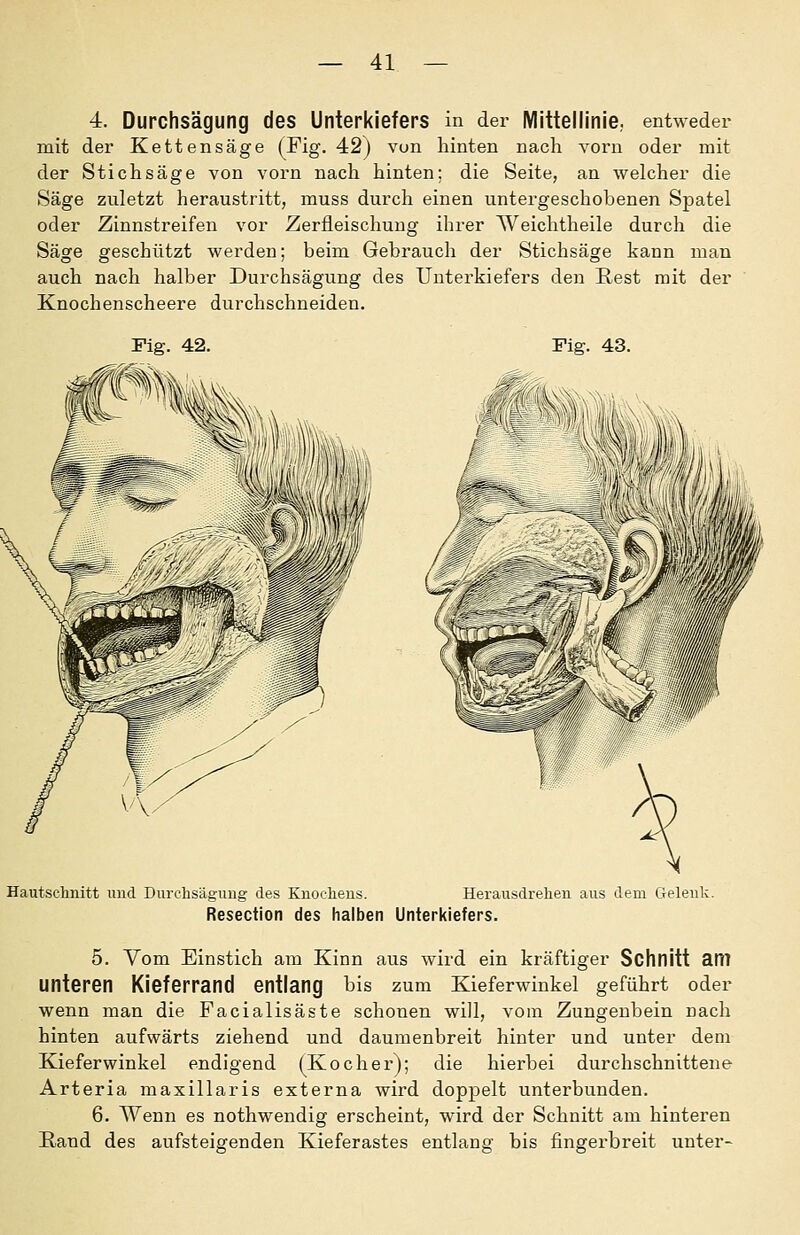 4. Durchsägung des Unterkiefers in der Mittellinie, entweder mit der Kettensäge (Fig. 42) vun hinten nach vorn oder mit der Stichsäge von vorn nach hinten; die Seite, an welcher die Säge zuletzt heraustritt, muss durch einen untergeschobenen Spatel oder Zinnstreifen vor Zerfleischuug ihrer Weichtheile durch die Säge geschützt werden; beim Gebrauch der Stichsäge kann man auch nach halber Durchsägung des Unterkiefers den Rest mit der Knochenscheere durchschneiden. Fig. 43. Hautschnitt und Durchsägung des Knoclieus. Herausdrehen aus dem Gelenk. Resection des halben Unterkiefers. 5. Vom Einstich am Kinn aus wird ein kräftiger Schnitt am unteren Kieferrand entlang bis zum Kieferwinkel geführt oder wenn man die Facialisäste schonen will, vom Zungenbein nach hinten aufwärts ziehend und daumenbreit hinter und unter dem Kieferwinkel endigend (Kocher); die hierbei durchschnittene Arteria maxillaris externa wird doppelt unterbunden. 6. Wenn es nothwendig erscheint, wird der Schnitt am hinteren E,and des aufsteigenden Kieferastes entlang bis fingerbreit unter-