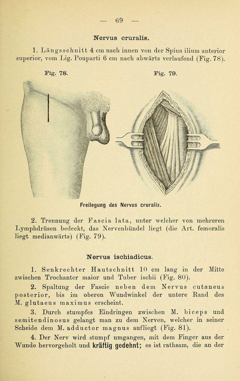 Nervus cruralis. 1. Längsschnitt 4 cm nach innen von der Spina ilium anterior superior, vom Lig. Pouparti 6 cm nach abwärts verlaufend (Fig. 78). Fig. 78. Fig. 79. r Freilegung des Nervus cruralis. 2. Trennung der Fascia lata, unter welcher von mehreren Lymphdrüsen bedeckt, das Nervenbündel liegt (die Art. femoralis liegt medianwärts) (Fig. 79). Nervus ischiadicus. 1. Senkrechter Hautschnitt 10 cm lang in der Mitte zwischen Trochanter maior und Tuber ischii (Fig. 80). 2. Spaltung der Fascie neben dem Nervus cutaneus posterior, bis im oberen Wundwinkel der untere Rand des M. glutaeus maximus erscheint. 3. Durch stumpfes Eindringen zwischen M. biceps und semitendinosus gelangt man zu dem Nerven, welcher in seiner Scheide dem M. adductor magnus aufliegt (Fig. 81). 4. Der Nerv wird stumpf umgangen, mit dem Finger aus der Wunde hervorgeholt und kräftig gedehnt; es ist rathsam, die an der