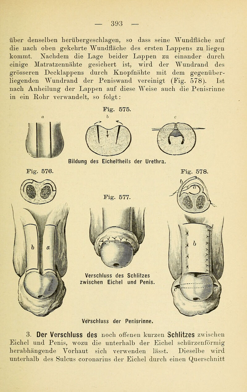 über denselben herübergeschlagen, so dass seine Wundfläche auf die nach oben gekehrte Wundfläche des ersten Lappens zu liegen kommt. Nachdem die Lage beider Lappen zu einander durch einige Matratzennähte gesichert ist, wird der Wundrand des grösseren Decklappens durch Knopfnähte mit dem gegenüber- liegenden AVundrand der Peniswand vereinigt (Fig. 578). Ist nach Anheilung der Lappen auf diese Weise auch die Penisrinne in ein Rohr verwandelt, so folgt: Fig. 575. \)i, Bildung des Eicheltheils der Urethra. Fig. 576. Fig. 578. Fig. 577. Verschluss des Schlitzes zwischen Eichel und Penis. Verschluss der Penisrinne. 3. Der Verschluss des noch ofFenen kurzen SchlitzeS zwischen Eichel und Penis, wozu die unterhalb der Eichel schürzenförinig herabhängende Vorhaut sich verwenden lässt. Dieselbe wird unterhalb des Sulcus coronarius der Eichel durch einen Querschnitt