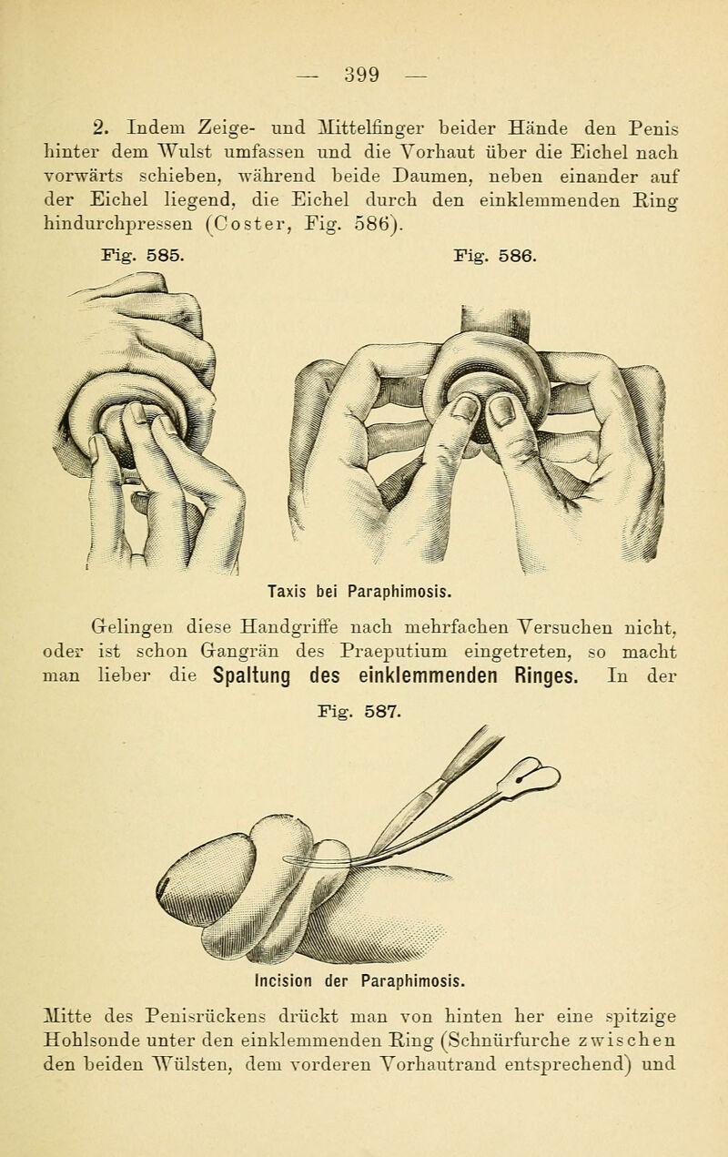 2. Indem Zeige- und llittelfinger beider Hände den Penis hinter dem Wulst umfassen und die Vorhaut über die Eichel nach vorwärts schieben, während beide Daumen, neben einander auf der Eichel liegend, die Eichel durch den einklemmenden Ring hindurchpressen (Co st er, Eig. 586). Fig. 585. Fig. 586. Taxis bei Paraphimosis. Gelingen diese Handgriffe nach mehrfachen Versuchen nicht, oder ist schon Gangrän des PraejDutium eingetreten, so macht man lieber die Spaltung des einklemmenden Ringes. In der Fig. 587. Incision der Paraphimosis. ilitte des Penisrückens drückt man von hinten her eine spitzige Hohlsonde unter den einklemmenden Ring (Schnürfurche zwischen den beiden Wülsten, dem vorderen Vorhautrand entsprechend) und