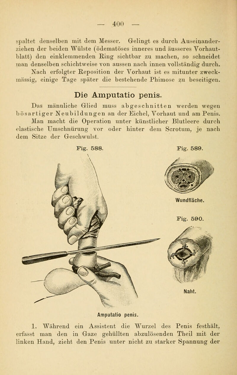 spaltet denselben mit dem Messer. Gelingt es durch Au.seinandex'- ziehen der beiden Wülste (ödematöses inneres und äusseres Vorhaut- blatt) den einklemmenden Ring sichtbar zu machen, so schneidet man denselben schichtweise von aussen nach innen vollständig durch. Nach erfolgter Reposition der Vorhaut ist es mitunter zweck- mässig, einige Tage später die bestehende Phimose zu beseitigen. Die Amputatio penis. Das männliche Grlied muss abgeschnitten werden wegen bösartiger Neubildungen an der Eichel, Vorhaut und am Penis. Man macht die Operation unter künstlicher Blutleere durch elastische Umschnürung vor oder hinter dem Scrotum, je nach dem Sitze der Geschwulst. Fig. 588. Fig. 589. Amputatio penis. 1. Während ein Assistent die Wurzel des Penis festhält, erfasst man den in Gaze gehüllten abzulösenden Theil mit der linken Hand, zieht den Penis unter nicht zu starker Spannung der