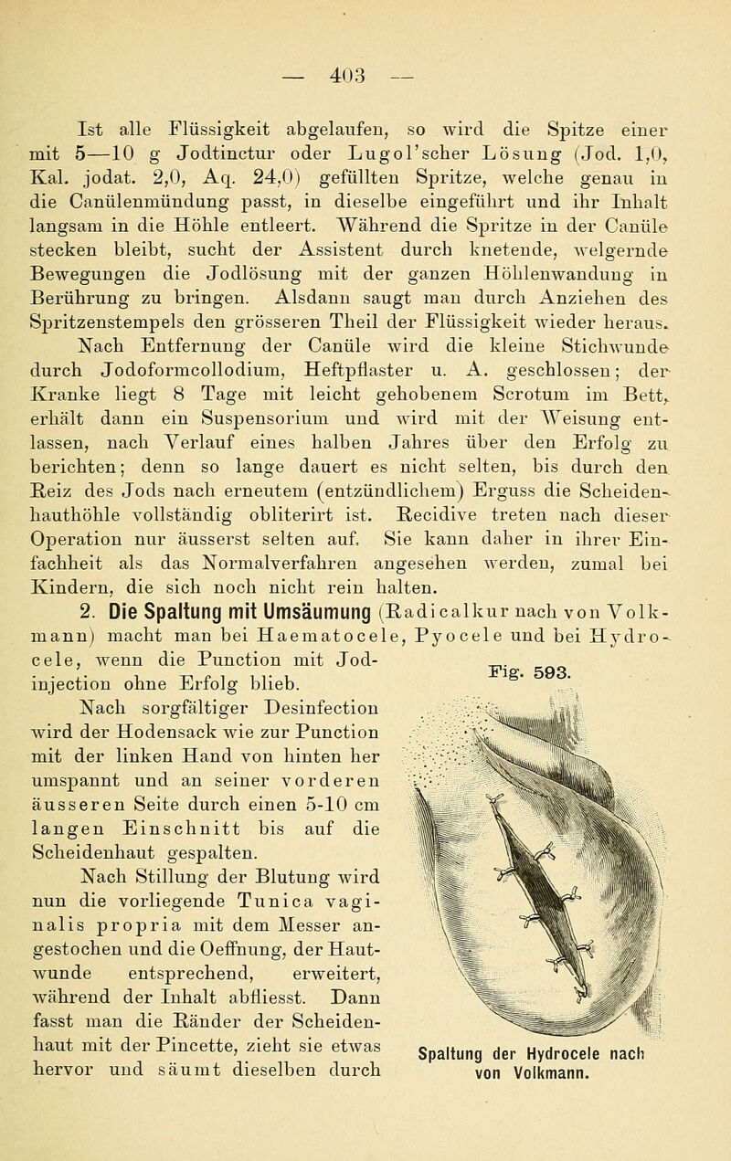 Ist alle Flüssigkeit abgelaufen, so wird die Spitze einer mit 5—10 g Jodtinctur oder Lugol'scher Lösung (Jod. 1,0, Kai. jodat. 2,0, Aq. 24,0) gefüllten Spritze, welche genau in die Canülenmündung passt, in dieselbe eingeführt und ihr Inhalt langsam in die Höhle entleert. Während die Spritze in der Canüle stecken bleibt, sucht der Assistent durch knetende, Avelgernde Bewegungen die Jodlösung mit der ganzen Höhlenwandung in Berührung zu bringen. Alsdann saugt man durch Anziehen des Spritzenstempels den grösseren Theil der Flüssigkeit wieder heraus» Nach Entfernung der Canüle wird die kleine StichAvunde- durch Jodoformcollodium, Heftpflaster u. A. geschlossen; der- Kranke liegt 8 Tage mit leicht gehobenem Scrotum im Bett,, erhält dann ein Susjoensorium und wird mit der Weisung ent- lassen, nach Verlauf eines halben Jahres über den Erfolg zu berichten; denn so lange dauert es nicht selten, bis durch den, Reiz des Jods nach erneutem (entzündlichem) Erguss die Scheiden- hauthöhle vollständig obliterirt ist. Recidive treten nach dieser Operation nur äusserst selten auf, Sie kann daher in ihrer Ein- fachheit als das Normalverfahren angesehen werden, zumal bei Kindern, die sich noch nicht rein halten. 2. Die Spaltung mit Umsäumung (Radicalkur nach von Volk- mann) macht man bei Haematocele, Pyocele und bei Hydro-- cele, wenn die Function mit Jod- injection ohne Erfolg blieb. Nach sorgfältiger Desinfection wird der Hodensack wie zur Function mit der linken Hand von hinten her umspannt und an seiner vorderen äusseren Seite durch einen 5-10 cm langen Einschnitt bis auf die Scheidenhaut gespalten. Nach Stillung der Blutung wird nun die vorliegende Tunica vagi- nalis propria mit dem Messer an- gestochen und die Oeffnung, der Haut- wunde entsprechend, erweitert, während der Inhalt abfliesst. Dann fasst man die Ränder der Scheiden- haut mit derFincette, zieht sie etwas Spaltung der Hydrocele nach hervor und säumt dieselben durch von Volkmann. Fig. 593.