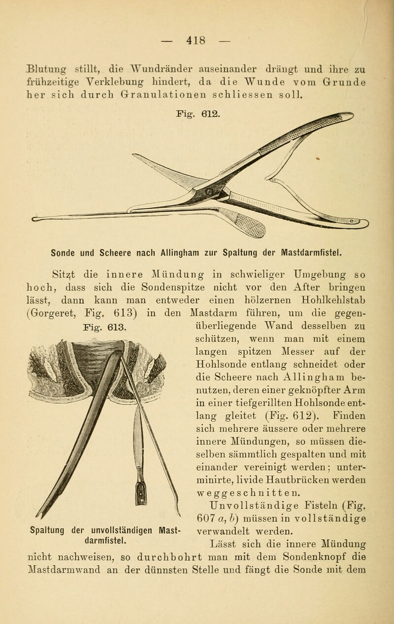 Blutung stillt, die ~\Vundrändei auseinander drängt und ihre zu frühzeitige Verklebung hindert, da die Wunde vom Grunde her sich durch Granulationen schliessen soll. Fig. 612. Sonde und Scheere nach Allingham zur Spaltung der Mastdarmfistel. Sitzjt die innere JMündung in schwieliger Umgehung so hoch, dass sich die Soudenspitze nicht vor den After bringen lässt, dann kann man entweder einen hölzernen Hohlkehlstab (Gorgeret, Fig. 613) in den Mastdarm führen, um die gegen- Fig. 613. überliegende Wand desselben zu schützen, wenn man mit einem langen spitzen Messer auf der Hohlsonde entlang schneidet oder die Scheere nach Allingham be- nutzen, deren einer geknöpfter Arm in einer tiefgerillten Hohlsonde ent- lang gleitet (Fig. 612). Finden sich mehrere äussere oder mehrere innere Mündungen, so müssen die- selben sämmtlich gespalten und mit einander vereinigt werden ; unter- minirte, livide Hautbrücken werden weggeschnitten. Unvollständige Fisteln (Fig. 607 a, A) müssen in vollständige verwandelt werden. Lässt sich die innere Mündung nicht nachweisen, so durchbohrt man mit dem Sondenknopf die Mastdarmwand an der dünnsten Stelle und fängt die Sonde mit dem Spaltung der unvollständigen Mast- darmfistel.