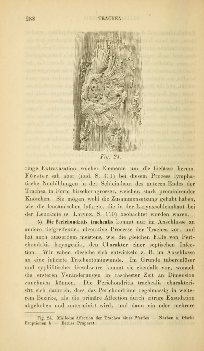 wwam ' Fig. 24. ringe Extravasaten solcher Elemente um die Gelasse herum. Förster sah aber (ibid. S. 311) bei diesem Process lympha- tische Neubildungen in der Schleimhaut des unteren Endes der Trachea in Form hirsekorngrosser, weicher, stark prominirender Knötchen. Sie mögen wohl die Zusammensetzung gehabt, haben, wie die Leucämischen Ini'arcte, die in der Larynxschleimhaut bei der Leucämie (s. Larynx, S. 110) beobachtet worden waren. 5) Die I'crichonilritis traehcnlis kommt nur im Anschlüsse an andere tiefgreifende, ulcerative Processe der Trachea vor, und hat auch ausserdem meistens, wie die gleichen Fälle von Peri- chondritis laryngealis, den Charakter einer septischen Infec- tion. Wir Bähen dieselbe sich entwickeln z. ß. im Anschlüsse an eine inficirte Traeheotomiewunde. Im Grunde tuberculöser und syphilitischer Geschwüre kommt sie ebenfalls vor, wonach die ersteren Veränderungen in raschester Zeit an Dimension zunehmen können. Die Perichondritis trachealis charakteri- -irt sieh dadurch, dass das I'erichondrium regelnnissig in weite- rem Bezirke, als die primäre Aftection durch eitrige Exsudation abgehoben und unterminirt wird, und dann ein oder mehrere I'ig 24. Malleöse Aü'ection der Trachea eines Pferdes — Narben a, frische Eruptionen l» Berner Präparat.