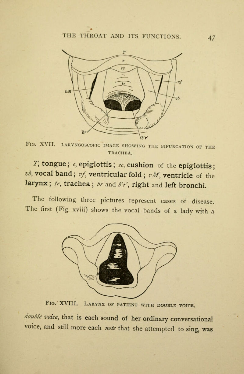 Fig. XVII. laryngoscopic image showing the bifurcation of the TRACHEA, r, ton^e; e, epiglottis; ec, cushion of the epiglottis; vb, vocal band; vf, ventricular fold ; tM, ventricle of the larynx ; tr, trachea ; br and Fr\ right and left bronchi. The following three pictures represent cases of disease. The first (Fig. xviii) shows the vocal bands of a lady with a Fig. XVIII. Larynx of patient with double voice. double voice, that is each sound of her ordinary conversational voice, and still more each note that she attempted to sing, was