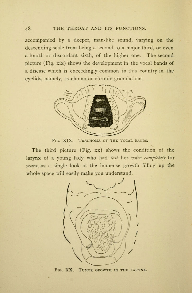 accompanied by a deeper, man-like sound, varying on the descending scale from being a second to a major third, or even a fourth or discordant sixth, of the higher one. The second picture (Fig. xix) shows the development in the vocal bands of a disease which is exceedingly common in this country in the eyelids, namely, trachoma or chronic granulations. Fig. xix. Trachoma of the vocal bands. The third picture (Fig. xx) shows the condition of the larynx of a young lady who had lost her voice completely for yearSy as a single look at the immense growth filling up the whole space will easilv make vou understand. Fig. XX. Tumor growth in the larynx.