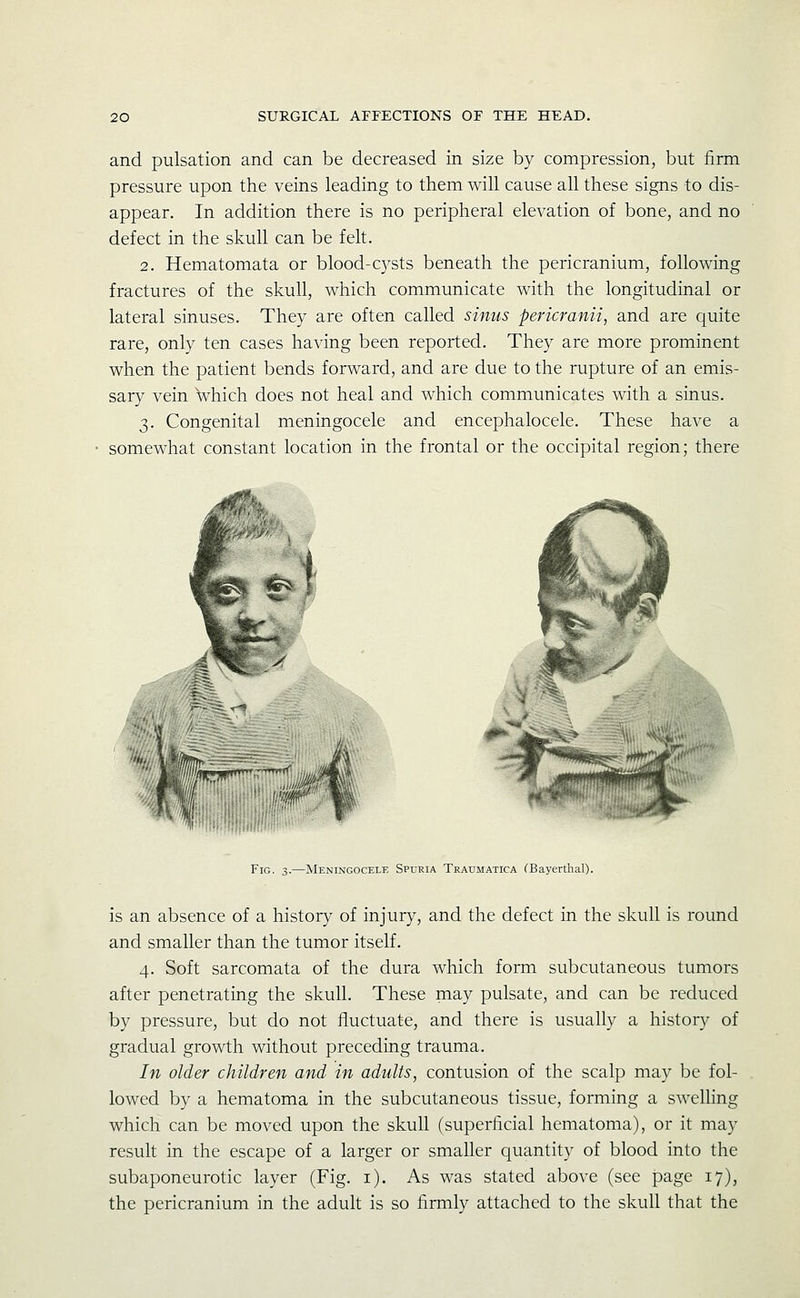 and pulsation and can be decreased in size by compression, but firm pressure upon the veins leading to them will cause all these signs to dis- appear. In addition there is no peripheral elevation of bone, and no defect in the skull can be felt. 2. Hematomata or blood-cysts beneath the pericranium, following fractures of the skull, which communicate with the longitudinal or lateral sinuses. They are often called sinus pericranii, and are quite rare, only ten cases having been reported. They are more prominent when the patient bends forward, and are due to the rupture of an emis- sary vein which does not heal and which communicates with a sinus. 3. Congenital meningocele and encephalocele. These have a somewhat constant location in the frontal or the occipital region; there '%MIII§^r^--'j0m, Fig. 3.—Meningocele Spuria Traumatica CBayertlial). is an absence of a history of injury, and the defect in the skull is round and smaller than the tumor itself. 4. Soft sarcomata of the dura which form subcutaneous tumors after penetrating the skull. These may pulsate, and can be reduced by pressure, but do not fluctuate, and there is usually a history of gradual growth without preceding trauma. In older children and in adults, contusion of the scalp may be fol- lowed by a hematoma in the subcutaneous tissue, forming a swelHng which can be moved upon the skull (superficial hematoma), or it may result in the escape of a larger or smaller quantity of blood into the subaponeurotic layer (Fig. i). As was stated above (see page 17), the pericranium in the adult is so firmly attached to the skull that the