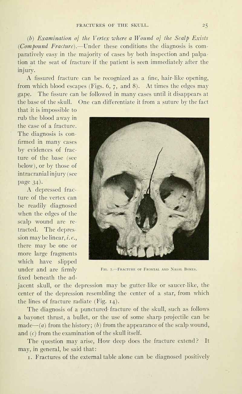 (b) Examination 0} the Vertex where a Wound 0} the Scalp Exists (Compound Fracture).—Under these conditions the diagnosis is com- paratively easy in the majority of cases by both inspection and palpa- tion at the seat of fracture if the patient is seen immediately after the injury. A fissured fracture can be recognized as a fine, hair-like opening, from which blood escapes (Figs. 6, 7, and 8). At times the edges may gape. The fissure can be followed in many cases until it disappears at the base of the skull. One can differentiate it from a suture by the fact that it is impossible to rub the blood away in the case of a fracture. The diagnosis is con- firmed in many cases by evidences of frac- ture of the base (see below), or by those of intracranial injury (see page 34)- A depressed frac- ture of the vertex can be readily diagnosed when the edges of the scalp wound are re- tracted. The depres- sion may be linear, 7'.^., there may be one or more large fragments which have slipped under and are firmly fixed beneath the ad- jacent skull, or the depression may be gutter-like or saucer-like, the center of the depression resembling the center of a star, from which the lines of fracture radiate (Fig. 14). The diagnosis of a punctured- fracture of the skull, such as follows a bayonet thrust, a bullet, or the use of some sharp projectile can be made—(a) from the history; (b) from the appearance of the scalp wound, and (c) from the examination of the skull itself. The question may arise. How deep does the fracture extend ? It may, in general, be said that: I. Fractures of the external table alone can be diagnosed positively Fig. 7.—Fracture of Frontal and Nasal Bones.