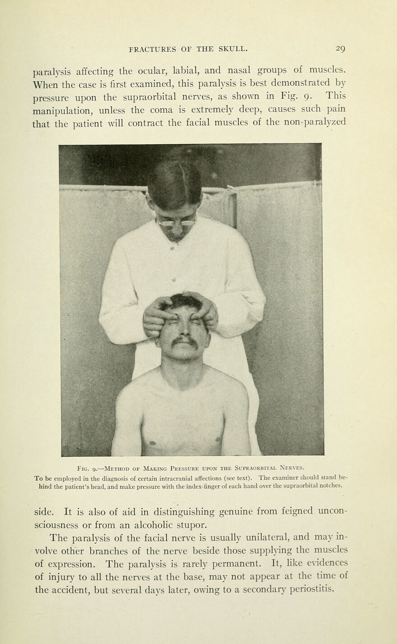 paralysis affecting the ocular, labial, and nasal groups of muscles. When the case is first examined, this paralysis is best demonstrated by pressure upon the supraorbital nen^es, as shown in Fig. 9. This manipulation, unless the coma is extremely deep, causes such pain that the patient will contract the facial muscles of the non-paralyzed Fig. g.—Method of AL^king pKLbSUKE upon the Supraorbital Ner\-es. To be employed in the diagnosis of certain intracranial affections (see text). The examiner should stand be- hind the patient's head, and make pressure with the index-finger of each hand over the supraorbital notches. side. It is also of aid in distinguishing genuine from feigned uncon- sciousness or from an alcohohc stupor. The paralysis of the facial nerve is usually unilateral, and may in- volve other branches of the nerve beside those supplying the muscles of expression. The paralysis is rarely permanent. It, like evidences of injury to all the nerves at the base, may not appear at the time of the accident, but several days later, owing to a secondar}^ periostitis.