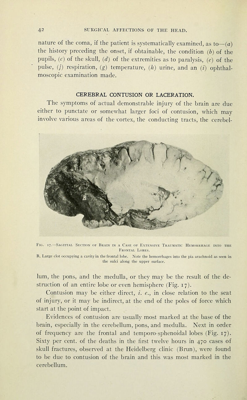 nature of the coma, if the patient is systematicahy examined, as to—(a) the history preceding the onset, if obtainable, the condition (b) of the pupils, (c) of the skull, (d) of the extremities as to paralysis, (e) of the pulse, (/) respiration, (g) temperature, (h) urine, and an (i) ophthal- moscopic examination made. CEREBRAL CONTUSION OR LACERATION. The symptoms of actual demonstrable injury of the brain are due either to punctate or somewhat larger foci of contusion, which may iavolve various areas of the cortex, the conducting tracts, the cerebel- -V. Fig. 17.—Sagittal Section of Brain in a Case of Extensive Traumatic Hemorrhage into the Frontal Lobes. B, Large clot occupying a cavity in the frontal lobe. Note the hemorrhages into the pia arachnoid as seen in the sulci along the upper surface. lum, the pons, and the medulla, or they may be the result of the de- struction of an entire lobe or even hemisphere (Fig. 17). Contusion may be either direct, i. e., in close relation to the seat of injury, or it may be indirect, at the end of the poles of force which start at the point of impact. Evidences of contusion are usually most marked at the base of the brain, especially in the cerebellum, pons, and medulla. Next in order of frequency are the frontal and temporo-sphenoidal lobes (Fig. 17). Sixty per cent, of the deaths in the first twelve hours in 470 cases of skull fractures, observed at the Heidelberg clinic (Brun), were found to be due to contusion of the brain and this was most marked in the cerebellum.