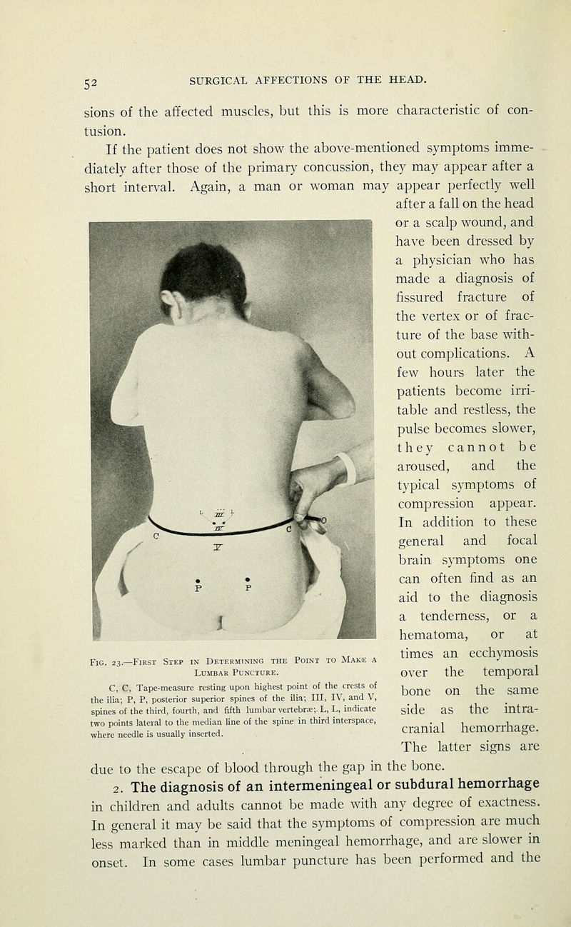 sions of the affected muscles, but this is more characteristic of con- tusion. If the patient does not show the above-mentioned symptoms imme- diately after those of the primary concussion, they may appear after a short interval. Again, a man or woman may appear perfectly well after a fall on the head or a scalp wound, and have been dressed by a physician who has made a diagnosis of fissured fracture of the vertex or of frac- ture of the base with- out complications. A few hours later the patients become irri- table and restless, the pulse becomes slower, they cannot be aroused, and the typical symptoms of compression appear. In addition to these general and focal i« brain symptoms one . • f can often find as an aid to the diagnosis a tenderness, or a hematoma, or at times an ecchymosis over the temporal bone on the same side as the intra- cranial hemorrhage. The latter signs are due to the escape of blood through the gap in the bone. 2. The diagnosis of an intermeningeal or subdural hemorrhage in children and adults cannot be made with any degree of exactness. In general it may be said that the symptoms of compression are much less marked than in middle meningeal hemorrhage, and are slower in onset. In some cases lumbar puncture has been performed and the Fig. 23.—First Step in Determining the Point to Make a Lumbar Puncture. C, C, Tape-measure resting upon highest point of the crests of the ilia; P, P, posterior superior spines of the ilia; III, IV, and V, spines of the third, fourth, and fifth lumbar vertebra;;. L, L, indicate two points lateral to the median line of the spine in third interspace, where needle is usually inserted.