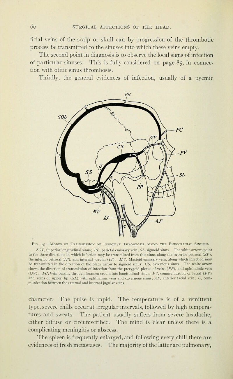 ficial veins of the scalp or skull can by progression of the thrombotic process be transmitted to the sinuses into which these veins empty. The second point in diagnosis is to obsen^e the local signs of infection of particular sinuses. This is fully considered on page 85, in connec- tion with otitic sinus thrombosis. Thirdly, the general evidences of infection, usually of a pyemic Fig. 25.—Modes of Traxsmission of Infective Thrombosis Along the Exdocraxial Sixuses. SOL, Superior longitudinal sinus; PE, parietal emissary vein; 55, sigmoid sinus. The white arrows point to the three directions in which infection may be transmitted from this sinus along the superior petrosal {SP), the inferior petrosal {IP), and internal jugular {If). MV, Mastoid emissary vein, along which infection may be transmitted in the direction of the black, arrow to sigmoid sinus; CS, cavernous sinus. The white arrow shows the direction of transmission of infection from the pterygoid plexus of veins {PP), and ophthalmic vein (.OV). FC, Vein passing through foramen cecum into longitudinal sinus; FF, communication of facial {FV) and veins of upper lip (5i),'n'ith ophthalmic vein and cavernous sinus; AF, anterior facial vein; C, com- .munication between the external and internal jugular veins. character. The pulse is rapid. The temperature is of a remittent type, severe chills occur at irregular intervals, followed by high tempera- tures and sweats. The patient usually suffers from severe headache, either diffuse or circumscribed. The mind is clear unless there is a complicating meningitis or abscess. The spleen is frequently enlarged, and following every chill there are evidences of fresh metastases. The majority of the latter arc pulmonary,