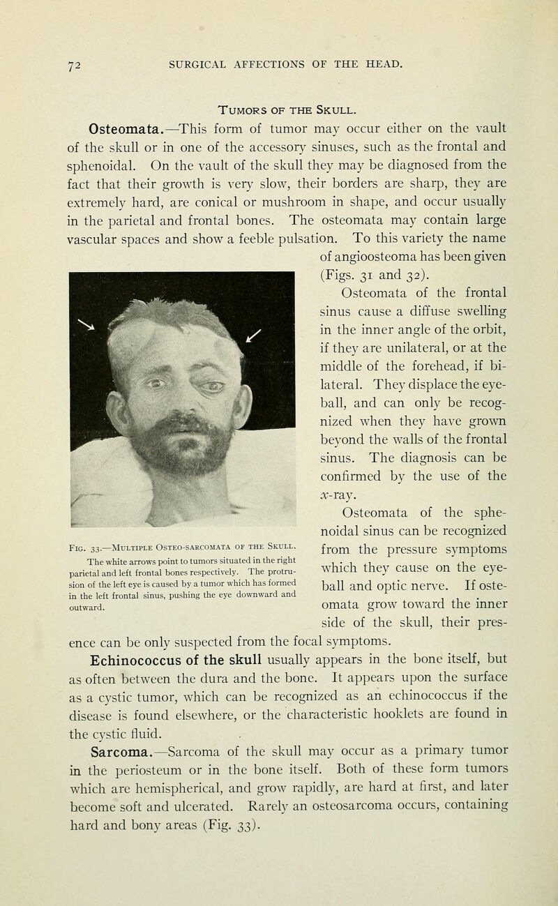 Tumors of the Skull. Osteomata.—^This form of tumor may occur either on the vault of the skull or in one of the accessory sinuses, such as the frontal and sphenoidal. On the vault of the skull they may be diagnosed from the fact that their growth is very slow, their borders are sharp, they are extremely hard, are conical or mushroom in shape, and occur usually in the parietal and frontal bones. The osteomata may contain large vascular spaces and show a feeble pulsation. To this variety the name of angioosteoma has been given (Figs. 31 and 32). Osteomata of the frontal sinus cause a diffuse swelling in the inner angle of the orbit, if they are unilateral, or at the middle of the forehead, if bi- lateral. They displace the eye- ball, and can only be recog- nized when they have grown beyond the walls of the frontal sinus. The diagnosis can be confirmed by the use of the X-TSLJ. Osteomata of the sphe- noidal sinus can be recognized from the pressure symptoms which they cause on the eye- ball and optic nen-e. If oste- omata grow toward the inner side of the skull, their pres- ence can be only suspected from the focal symptoms. Echinococcus of the skull usually appears in the bone itself, but as often between the dura and the bone. It appears upon the surface as a cystic tumor, which can be recognized as an echinococcus if the disease is found elsewhere, or the characteristic booklets are found in the cystic fluid. Sarcoma.—Sarcoma of the skull may occur as a primary tumor in the periosteum or in the bone itself. Both of these form tumors which are hemispherical, and grow rapidly, are hard at first, and later become soft and ulcerated. Rarely an osteosarcoma occurs, containing hard and bony areas (Fig. 33). Fig. 33.—Multiple Osteo-sarcomata of the Skull. The white arrows point to tumors situated in the right parietal and left frontal bones respectively. The protru- sion of the left eye is caused by a tumor which has formed in the left frontal sinus, pushing the eye downward and outward.