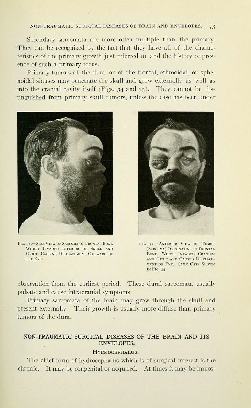 Secondary sarcomata are more often multiple than the primary. They can be recognized by the fact that they have all of the charac- teristics of the primary growth just referred to, and the history or pres- ence of such a primary focus. Primary tumors of the dura or of the frontal, ethmoidal, or sphe- noidal sinuses may penetrate the skull and grow externally as well as into the cranial cavity itself (Figs. 34 and 35). They cannot be dis- tinguished from primary skull tumors, unless the case has been under Fig. 34.—Side View of Sarcoma of Frontal Bone Which Invaded Interior of Skull and Orbit, Causing Displacement Outward of THE Eye. Fig. 35.—Anterior View of Tumor (Sarcoma) Originating in Frontal . Bone, Which Invaded Cranium AND Orbit and Caused Displace- ment of Eye. Same Case Shown IN Fig. 34. observation 'from the earliest period. These dural sarcomata usually pulsate and cause intracranial symptoms. Primary sarcomata of the brain may grow through the skull and present externally. Their growth is usually more diffuse than primary tumors of the dura. NON-TRAUMATIC SURGICAL DISEASES OF THE BRAIN AND ITS ENVELOPES. Hydrocephalus. The chief form of hydrocephalus which is of surgical interest is the chronic. It may be congenital or acquired. At times it may be impos-