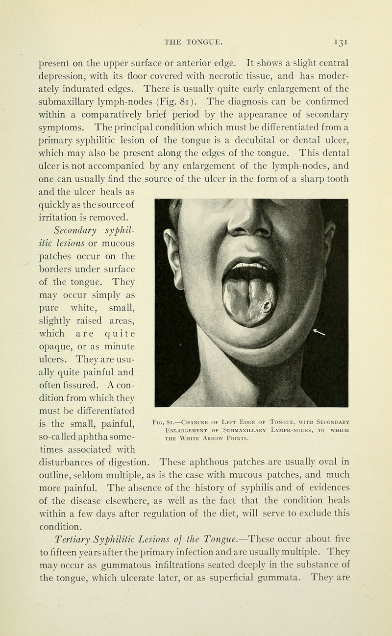 present on the upper surface or anterior edge. It shows a sHght central depression, with its floor covered with necrotic tissue, and has moder- ately indurated edges. There is usually quite early enlargement of the submaxillary lymph-nodes (Fig. 81). The diagnosis can be confirmed within a comparatively brief period by the appearance of secondary symptoms. The principal condition which must be differentiated from a primary syphihtic lesion of the tongue is a decubital or dental ulcer, which may also be present along the edges of the tongue. This dental ulcer is not accompanied by any enlargement of the lymph-nodes, and one can usually find the source of the ulcer in the form of a sharp tooth and the ulcer heals as quickly as the source of irritation is removed. Secondary syphil- itic lesions or mucous patches occur on the borders under surface of the tongue. They may occur simply as pure white, small, slightly raised areas, which are quite opaque, or as minute ulcers. They are usu- ally quite painful and often fissured. A con- dition from which they must be differentiated is the small, painful, so-called aphtha some- times associated with disturbances of digestion. These aphthous patches are usually oval in outline, seldom multiple, as is the case with mucous patches, and much more painful. The absence of the history of syphilis and of evidences of the disease elsewhere, as well as the fact that the condition heals within a few days after regulation of the diet, will serve to exclude this condition. Tertiary Syphilitic Lesions 0} the Tongue.—These occur about five to fifteen years after the primary infection and are usually multiple. They may occur as gummatous infiltrations seated deeply in the substance of the tongue, which ulcerate later, or as superficial gummata. They are Fig. 81.—Chancre of Left Edge of Tongue, with Secondary Enlargement of Submaxillary Lymph-nodes, to which THE White Arrow Points.