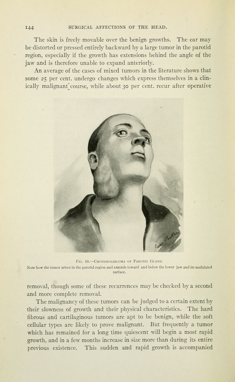 The skin is freely movable over the benign gro^Yths. The ear may be distorted or pressed entirely backward by a large tumor in the parotid region, especially if the growth has extensions behind the angle of the jaw and is therefore unable to expand anteriorly. An average of the cases of mixed tumors in the Kterature shows that some 25 per cent, undergo changes which express themselves in a cHn- ically malignant\'ourse, while about 30 per cent, recur after operative Fig. 88.—CHONDROSARC0iL\ OF Parotid Glant). Note how the tumor arises in the parotid region and extends toward and below the lower jaw and its nodulated surface. removal, though some of these recurrences may be checked by a second and more complete removal. The mahgnancy of these tumors can be judged to a certain extent by their slo\\Tiess of growth and their physical characteristics. The hard fibrous and cartilaginous tumors are apt to be benign, while the soft cellular tvpes are hkelv to prove mahgnant. But frequently a tumor which has remained for a long time quiescent wiU begin a most rapid growth, and in a few months increase in size more than during its entire previous existence. This sudden and rapid growth is accompanied