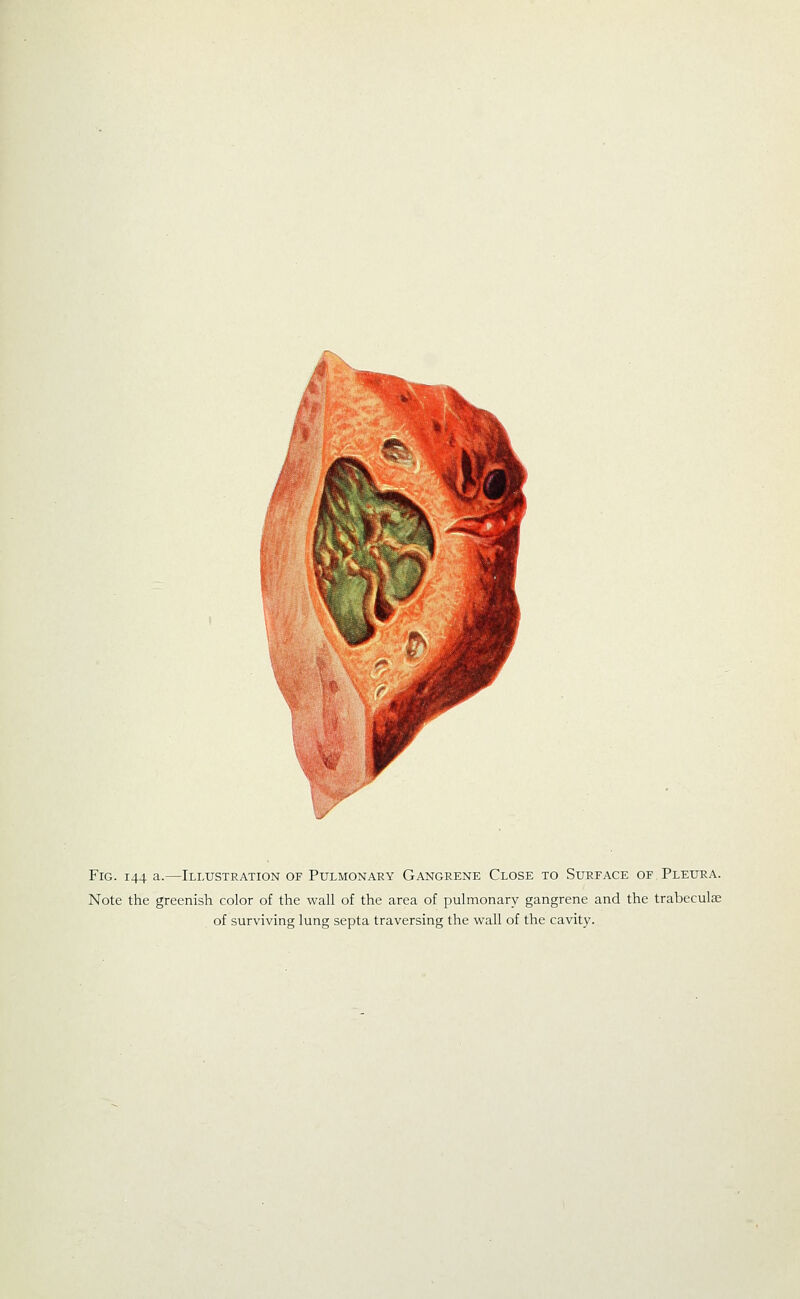 Fig. 144 a.—Illustration of Pulmonary Gangrene Close to Surface of Pleura. Note the greenish color of the wall of the area of pulmonary gangrene and the trabeculas of surviving lung septa traversing the wall of the cavity.