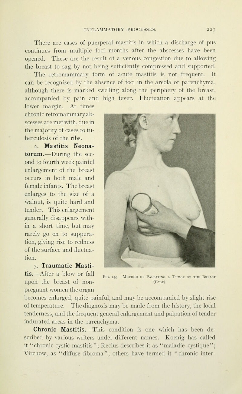 There are cases of puerperal mastitis in which a discharge of pus continues from muhiple foci months after the abscesses have been opened. These are the result of a venous congestion due to allowing the breast to sag by not being sufficiently compressed and supported. The retromammary form of acute mastitis is not frequent. It can be recognized by the absence of foci in the areola or parenchyma, although there is marked swelling along the periphery of the breast, accompanied by pain and high fever. Fluctuation appears at the lower margin. At times chronic retromammary ab- scesses are met with, due in the majority of cases to tu- berculosis of the ribs. 2. Mastitis Neona- torum.—During the sec- ond to fourth week painful enlargement of the breast occurs in both male and female infants. The breast enlarges to the size of a walnut, is quite hard and tender. This enlargement generally disappears with- in a short time, but may rarely go on to suppura- tion, giving rise to redness of the surface and fluctua- tion. 3. Traumatic Masti- tis.—After a blow or fall upon the breast of non- pregnant women the organ becomes enlarged, quite painful, and may be accompanied by slight rise of temperature. The diagnosis jnay be made from the history, the local tenderness, and the frequent general enlargement and palpation of tender indurated areas in the parenchyma. Chronic Mastitis.—This condition is one which has been de- scribed by various writers under different names. Koenig has called it chronic cystic mastitis; Reclus describes it as maladie cystique; Virchow, as diffuse fibroma; others have termed it chronic inter- FiG. 149.—Method of Palpating a Tumor of the Breast (Cyst).