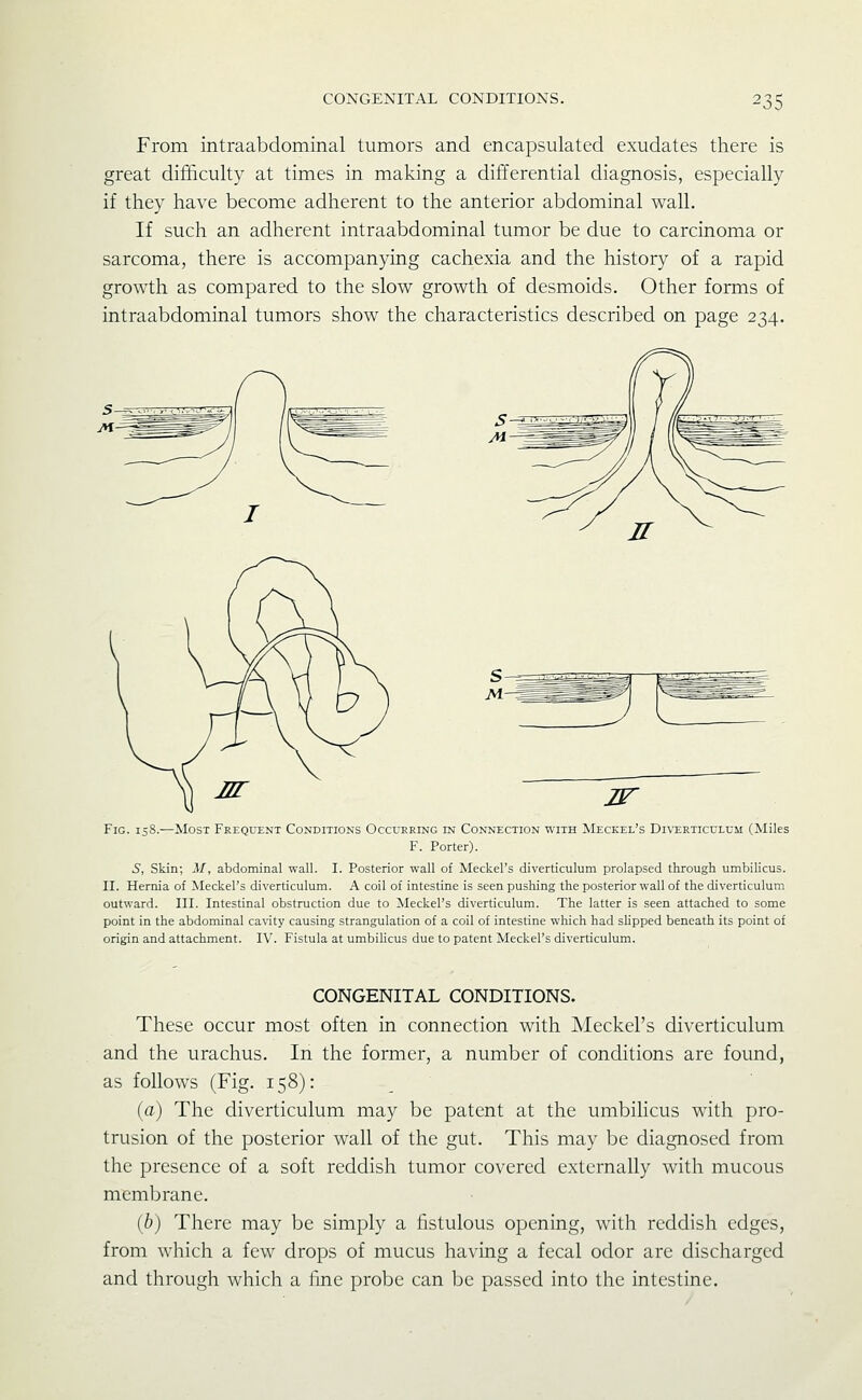 From intraabdominal tumors and encapsulated exudates there is great difficulty at times in making a differential diagnosis, especially if they have become adherent to the anterior abdominal wall. If such an adherent intraabdominal tumor be due to carcinoma or sarcoma, there is accompanying cachexia and the history of a rapid growth as compared to the slow growth of desmoids. Other forms of intraabdominal tumors show the characteristics described on page 234. IT Fig. 158.—Most Frequent Conditions Occurring in Connection with Meckel's Diverticulum (Miles F. Porter). 5, Skin; M, abdominal wall. I. Posterior wall of Meckel's diverticulum prolapsed through umbilicus. II. Hernia of Meckel's diverticulum. A coil of intestine is seen pushing the posterior wall of the diverticulum outward. III. Intestinal obstruction due to Meckel's diverticulum. The latter is seen attached to some point in the abdominal cavity causing strangulation of a coil of intestine which had slipped beneath its point of origin and attachment. IV. Fistula at umbilicus due to patent Meckel's diverticulum. CONGENITAL CONDITIONS. These occur most often in connection with Meckel's diverticulum and the urachus. In the former, a number of conditions are found, as follows (Fig. 158): (a) The diverticulum may be patent at the umbilicus with pro- trusion of the posterior wall of the gut. This may be diagnosed from the presence of a soft reddish tumor covered externally with mucous membrane. ih) There may be simply a fistulous opening, with reddish edges, from which a few drops of mucus having a fecal odor are discharged and through which a fine probe can be passed into the intestine.