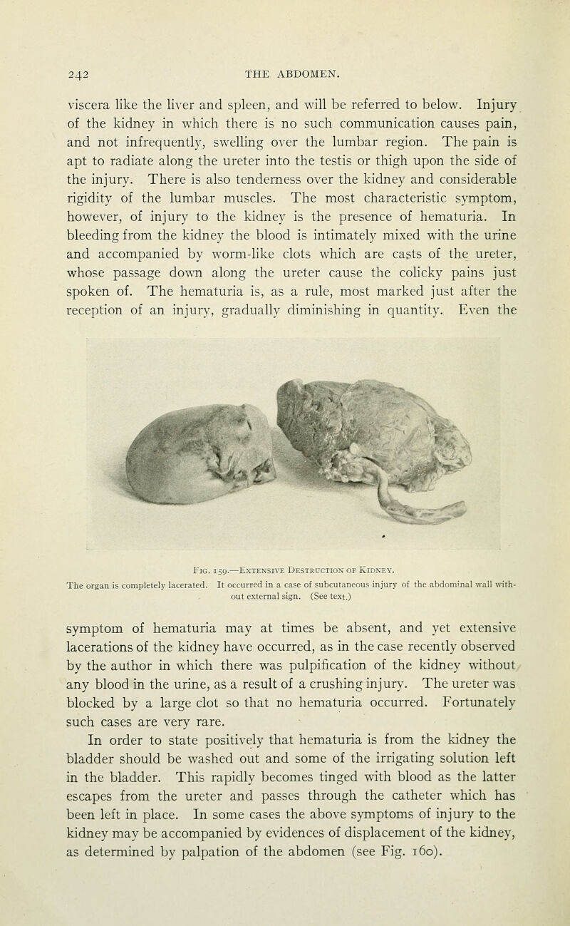 viscera like the liver and spleen, and will be referred to below. Injury of the kidney in which there is no such communication causes pain, and not infrequently, swelling over the lumbar region. The pain is apt to radiate along the ureter into the testis or thigh upon the side of the injury. There is also tenderness over the kidney and considerable rigidity of the lumbar muscles. The most characteristic symptom, however, of injury to the kidney is the presence of hematuria. In bleeding from the kidney the blood is intimately mixed with the urine and accompanied by worm-like clots which are casts of the ureter, whose passage down along the ureter cause the colicky pains just spoken of. The hematuria is, as a rule, most marked just after the reception of an injury, gradually diminishing in quantity. Even the Fig. 159.—Extensive Destruction of Kidney. The organ is completely lacerated. It occurred in a case of subcutaneous injury of the abdominal wall with- out external sign. (See text.) symptom of hematuria may at times be absent, and yet extensive lacerations of the kidney have occurred, as in the case recently observed by the author in which there was pulpification of the kidney without any blood in the urine, as a result of a crushing injury. The ureter was blocked by a large clot so that no hematuria occurred. Fortunately such cases are very rare. In order to state positively that hematuria is from the kidney the bladder should be washed out and some of the irrigating solution left in the bladder. This rapidly becomes tinged with blood as the latter escapes from the ureter and passes through the catheter which has been left in place. In some cases the above symptoms of injury to the kidney may be accompanied by evidences of displacement of the kidney, as determined by palpation of the abdomen (see Fig. 160).