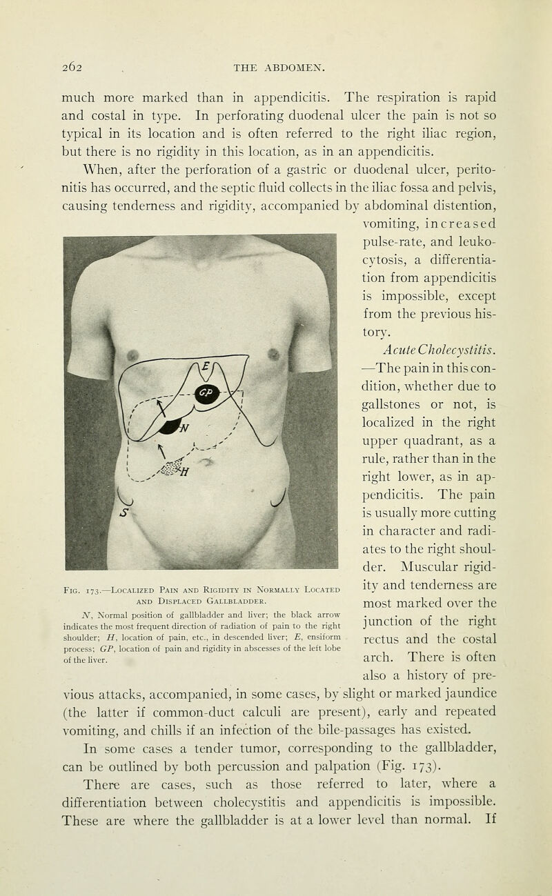 much more marked than in appendicitis. The respiration is rapid and costal in type. In perforating duodenal ulcer the pain is not so typical in its location and is often referred to the right iliac region, but there is no rigidity in this location, as in an appendicitis. When, after the perforation of a gastric or duodenal ulcer, perito- nitis has occurred, and the septic fluid collects in the iliac fossa and pelvis, causing tenderness and rigidity, accompanied by abdominal distention, vomiting, increased pulse-rate, and leuko- cytosis, a differentia- tion from appendicitis is impossible, except from the previous his- tory. A cute Ch olecystitis. —The pain in this con- dition, whether due to gallstones or not, is localized in the right upper quadrant, as a rule, rather than in the right lower, as in ap- pendicitis. The pain is usually more cutting in character and radi- ates to the right shoul- der. Muscular rigid- ity and tenderness are most marked over the junction of the right rectus and the costal arch. There is often also a history of pre- vious attacks, accompanied, in some cases, by shght or marked jaundice (the latter if common-duct calcuK are present), early and repeated vomiting, and chills if an infection of the bile-passages has existed. In some cases a tender tumor, corresponding to the gallbladder, can be outlined by both percussion and palpation (Fig. 173). There are cases, such as those referred to later, where a differentiation between cholecystitis and appendicitis is impossible. These are where the gallbladder is at a lower level than normal. If Fig. 173.—Localized Pain and Rigidity in Normally Located AND Displaced Gallbladder. N, Normal position of gallbladder and liver; the black arrow indicates the most frequent direction of radiation of pain to the right shoulder; H, location of pain, etc., in descended Uver; E, ensiform process; GP, location of pain and rigidity in abscesses of the left lobe of the liver.