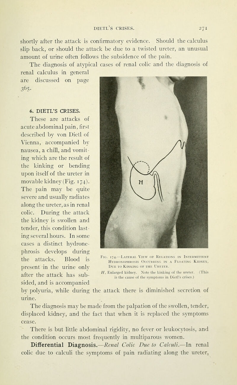 dietl's crises. shortly after the attack is confirmatory evidence. Should the calculus slip back, or should the attack be due to a twisted ureter, an unusual amount of urine often follows the subsidence of the pain. The diagnosis of atypical cases of renal coKc and the diagnosis of renal calculus in general are discussed on page 365- 6. DIETL'S CRISES. These are attacks of acute abdominal pain, first described by von Dietl of Vienna, accompanied by nausea, a chill, and vomit- ing which are the result of the kinking or bending upon itself of the ureter in movable kidney (Fig. 174). The pain may be quite severe and usually radiates along the ureter, as in renal colic. During the attack the kidney is sw^ollen and tender, this condition last- ing several hours. In some cases a distinct hydrone- phrosis develops during the attacks. Blood is present in the urine only after the attack has sub- sided, and is accompanied by polyuria, while during the attack there is diminished secretion of urine. The diagnosis may be made from the palpation of the swollen, tender, displaced kidney, and the fact that when it is replaced the symptoms cease. ^ There is but little abdominal rigidity, no fever or leukocytosis, and the condition occurs most frequently in muciparous women. Differential Diagnosis.—Renal Colic Due to Calculi.—In renal colic due to calculi the symptoms of pain radiating along the ureter, Fig. 174.—Lateral View of Relations in Intermittent Hydronephrosis Occurring in a Floating Kidney, Due to Kinking of the Ureter. H, Enlarged kidney. Note the kinking of the ureter. (This is the cause of the symptoms in Dietl's crises.)