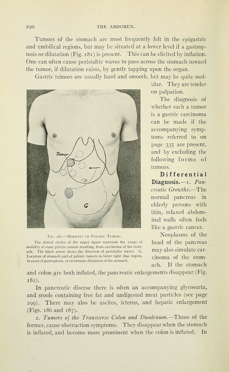 Tumors of the stomach are most frequently felt in the epigastric and umbilical regions, but may be situated at a lower level if a gastrop- tosis or dilatation (Fig. 181) is present. This can be elicited by inflation. One can often cause peristaltic waves to pass across the stomach toward the tumor, if dilatation exists, by gently tapping upon the organ. Gastric tumors are usually hard and smooth, but may be quite nod- ular. They are tender on palpation. The diagnosis of whether such a tumor is a gastric carcinoma can be made if the accompanying symp- toms referred to on page 335 are present, and by excluding the following forms of tumors. Differential Diagnosis.—i. Pan- creatic Growths.—The normal pancreas in elderly persons with thin, relaxed abdom- inal walls often feels like a gastric cancer. Neoplasms of the head of the pancreas may also simulate car- cinoma of the stom- ach. If the stomach and colon are both inflated, the pancreatic enlargements disappear (Fig. 182). In pancreatic disease there is often an accompanying glycosuria, and stools containing free fat and undigested meat particles (see page 299). There may also be ascites, icterus, and hepatic enlargement (Figs. 186 and 187). 2. Tumors of the Transverse Colon and Duodenum.—Those of the former, cause obstruction symptoms. They disappear when the stomach is inflated, and become more prominent when the colon is inflated. In Fig. 181.—Mobility of Pyloric Tumoks. The dotted circles of the upper figure represent the range of mobih'ty of some pyloric tumors resulting from carcinoma of the stom- ach. The black arrow shows the direction of peristaltic waves. G, Location of stomach and of pyloric tumors in latter right iliac region, in cases of gastroptosis, or of extreme dilatation of the stomach.