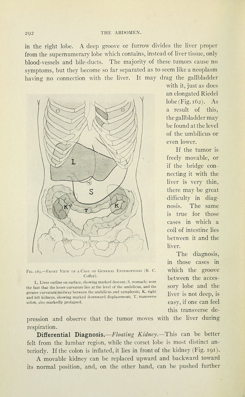 in the right lobe. A deep groove or furrow divides the hver proper from the supemumerar}^ lobe which contains, instead of liver tissue, only blood-vessels and bile-ducts. The majority of these tumors cause no symptoms, but they become so far separated as to seem hke a neoplasm having no connection with the liver. It may drag the gallbladder with it, just as does an elongated Riedei lobe (Fig. 162). As a result of this, the gallbladder may be found at the level of the umbilicus or even lower. If the tumor is freely movable, or if the bridge con- necting it with the liver is very thin, there may be great difficulty in diag- nosis. The same is true for those cases in which a coil of intestine lies between it and the liver. The diagnosis, in those cases in which the groove between the acces- sory lobe and the liver is not deep, is easy, if one can feel this transverse de- pression and observe that the tumor moves with the liver during respiration. Differential Diagnosis.—Floating Kidney.—This can be better felt from the lumbar region, while the corset lobe is most distinct an- teriorly. If the colon is inflated, it Hes in front of the kidney (Fig. 191). A movable kidney can be replaced upward and backward toward its noi-mal position, and, on the other hand, can be pushed further Fig. 183.—Front View op a Case of General Enteroptosis (R. C. Coffey). L, Liver outline on surface, sho-n-ing marked descent; S, stomach; note the fact that the lesser curvature lies at the level of the umbilicus, and the greater curvature midway between the umbilicus and symphysis; K, right and left kidneys, showing marked do\vnward displacement; T, transverse colon, also markedly prolapsed.