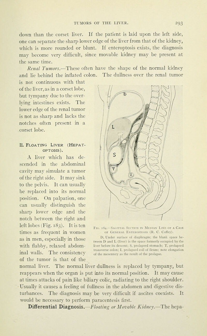 dovm than the corset liver. If the patient is laid upon the left side, one can separate the sharp lower edge of the liver from that of the kidney, which is more rounded or blunt. If enteroptosis exists, the diagnosis may become very difficult, since movable kidney may be present at the same time. Renal Tumors.—These often have the shape of the normal kidney and he behind the inflated colon. The dullness over the renal tumor is not continuous with that of the hver, as in a corset lobe, ^ '' v'^l/'>o but tympany due to the over- lying intestines exists. The lower edge of the renal tumor is not as sharp and lacks the notches often present in a corset lobe. II. Floating Liver (Hepat- OPTOSIS). A liver which has de- scended in the abdominal cavity may simulate a tumor of the right side. It may sink to the pelvis. It can usually be replaced into its normal position. On palpation, one can usually distinguish the sharp lower edge and the notch between the right and left lobes (Fig. 183). It is ten times as frequent in women as in men, especially in those with flabby, relaxed abdom- inal walls. The consistency of the tumor is that of the normal liver. The normal hver dullness is replaced by tympany, but reappears when the organ is put into its normal position. It may cause at times attacks of pain like biliary colic, radiating to the right shoulder. -Usually it causes a feeling of fullness in the abdomen and digestive dis- turbances. The diagnosis may be very difficult if ascites coexists. It would be necessary to perform paracentesis first. Differential Diagnosis.—Floating or Movable Kidney.—The hepa- FiG. 184.—Sagittal Section in Median Line of a Case OF General Enteroptosis (R. C. Cofifey). D, Under surface of diaphragm; the blank space be- tween D and L (liver) is the space formerly occupied by the liver before its descent; S, prolapsed stomach; T, prolapsed transverse colon; I, prolapsed coil of ileum; note elongation of the mesentery as the result of the prolapse.