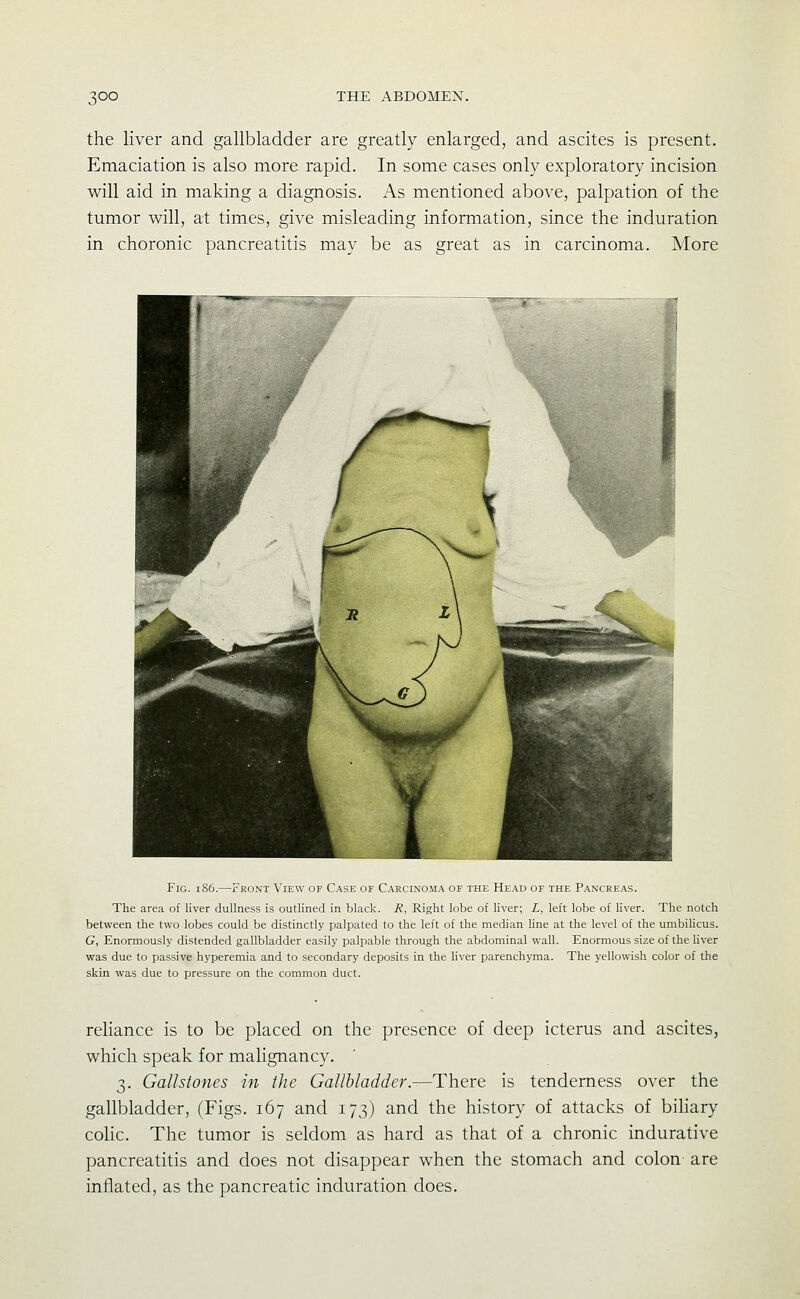 the liver and gallbladder are greatly enlarged, and ascites is present. Emaciation is also more rapid. In some cases only exploratory incision will aid in making a diagnosis. As mentioned above, palpation of the tumor will, at times, give misleading information, since the induration in choronic pancreatitis may be as great as in carcinoma. More Fig. iS6.—Front View of Case of Carcinoma of the Head of the Pancreas. The area of liver dullness is outlined in black. R, Right lobe of liver; L, left lobe of Kver. The notch between the two lobes could be distinctly palpated to the left of the median Hne at the level of the umbihcus. G, Enormously distended gallbladder easily palpable through the abdominal wall. Enormous size of the liver was due to passive hyperemia and to secondary deposits in the liver parenchyma. The yellowish color of the skin was due to pressure on the common duct. rehance is to be placed on the presence of deep icterus and ascites, which speak for mahgnancy. 7,. Gallstones in the Gallbladder.—There is tenderness over the gallbladder, (Figs. 167 and 173) and the history of attacks of biliary coHc. The tumor is seldom as hard as that of a chronic indurative pancreatitis and does not disappear when the stomach and colon are inflated, as the pancreatic induration does.