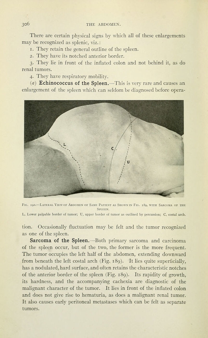 There are certain physical signs by which all of these enlargements may be recognized as splenic, viz. : 1. They retain the general outhne of the spleen. 2. They have its notched anterior border. 3. They he in front of the inflated colon and not behind it, as do renal tumors. 4. They have respiratory mobility. (a) Echinococcus of the Spleen.—This is very rare and causes an enlargement of the spleen which can seldom be diagnosed before opera- r w ^ V / ' i 1 / ' ^^^' / ; ^^P / / x \L / / ;' ,; ■j jk '\^ c/ /u . .-rcvi p 1 6. * ' Fig. 190.—Lateral View or Abdoiten of Same Patiext as Sho\^nin Fig. 1S9, with S.\rcoma of the Spleen. L, Lower palpable border of tumor; U, upper border of tumor as outlined by percussion; C, costal arch. tion. Occasionally fluctuation may be felt and the tumor recognized as one of the spleen. Sarcoma of the Spleen.—Both primary sarcoma and carcinoma of the spleen occur, but of the two, the former is the more frequent. The tumor occupies the left half of the abdomen, extending do\^Tlward from beneath the left costal arch (Fig. 189). It lies quite superficially, has a nodulated, hard surface, and often retains the characteristic notches of the anterior border of the spleen (Fig. 189). Its rapidity of growth, its hardness, and the accompanying cachexia are diagnostic of the malignant character of the tumor. It lies in front of the inflated colon and does not give rise to hematuria, as does a mahgnant renal tumor. It also causes early peritoneal metastases which can be felt as separate tumors.