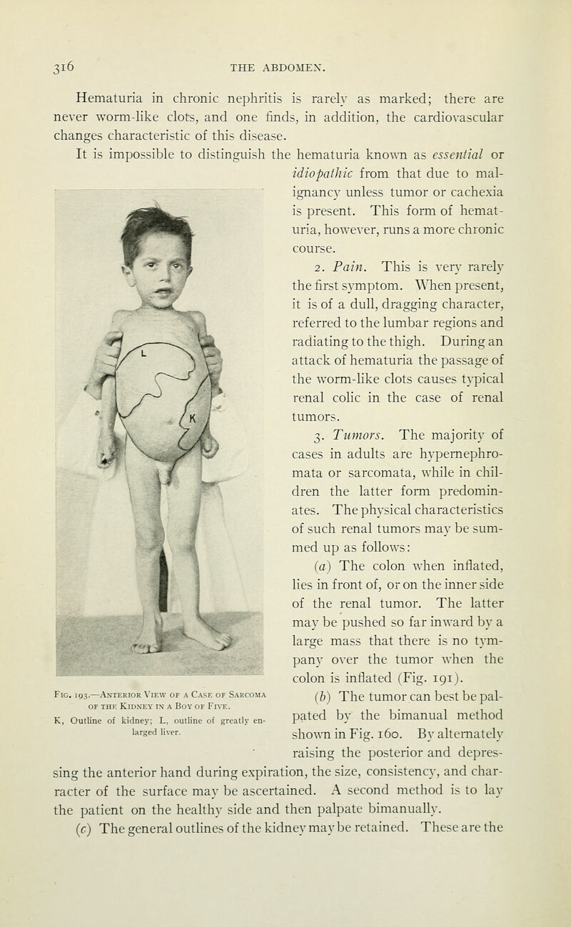 Hematuria in chronic nephritis is rarely as marked; there are never worm-Hke clots, and one finds, in addition, the cardiovascular changes characteristic of this disease. It is impossible to distinguish the hematuria known as essential or idiopathic from that due to mal- ignancy unless tumor or cachexia is present. This form of hemat- uria, however, runs a more chronic course. 2. Pain. This is very rarely the first symptom. When present, it is of a dull, dragging character, referred to the lumbar regions and radiating to the thigh. During an attack of hematuria the passage of the worm-Hke clots causes typical renal colic in the case of renal tumors. 3. Tumors. The majority of cases in adults are hypemephro- mata or sarcomata, while in chil- dren the latter form predomin- ates. The physical characteristics of such renal tumors may be sum- med up as follows: (a) The colon when inflated, lies in front of, or on the inner side of the renal tumor. The latter may be pushed so far inward by a large mass that there is no tym- pany over the tumor when the colon is inflated (Fig. 191). {h) The tumor can best be pal- pated by the bimanual method shown in Fig. 160. By alternately raising the posterior and depres- sing the anterior hand during expiration, the size, consistency, and char- racter of the surface may be ascertained. A second method is to lay the patient on the heahhy side and then palpate bimanually. {c) The general outlines of the kidney may be retained. These are the Fig. 193.—^Anterior View of a Case of Sarcoma OF THE Kidney in a Boy of Fi\-e. K, Outline of kidney; L, outline of greatly en- larged liver.