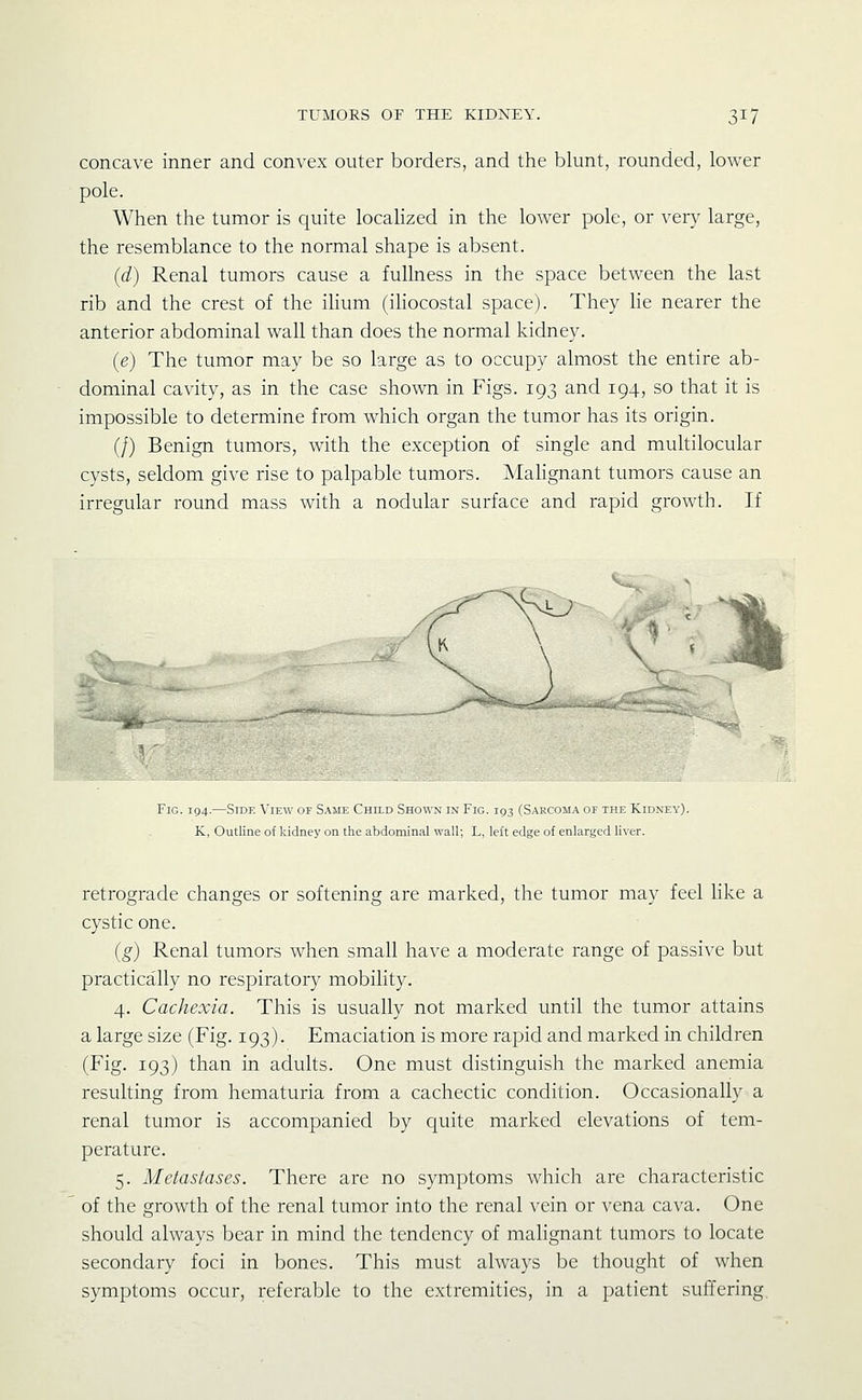 concave inner and convex outer borders, and the blunt, rounded, lower pole. When the tumor is quite localized in the lower pole, or very large, the resemblance to the normal shape is absent. {d) Renal tumors cause a fullness in the space between the last rib and the crest of the ihum (ihocostal space). They lie nearer the anterior abdominal wall than does the normal kidney. {e) The tumor may be so large as to occupy almost the entire ab- dominal cavity, as in the case shown in Figs. 193 and 194, so that it is impossible to determine from which organ the tumor has its origin. (/) Benign tumors, with the exception of single and multilocular cysts, seldom give rise to palpable tumors. MaHgnant tumors cause an irregular round mass with a nodular surface and rapid growth. If IS.. Fig. 194.—Side View of Same Child Shown in Fig. 193 (Sarcoma of the Kidney). K, Outline of kidney on the abdominal wall; L, left edge of enlarged liver. retrograde changes or softening are marked, the tumor may feel like a cystic one. {g) Renal tumors when small have a moderate range of passive but practically no respiratory mobility. 4. Cachexia. This is usually not marked until the tumor attains a large size (Fig. 193). Emaciation is more rapid and marked in children (Fig. 193) than in adults. One must distinguish the marked anemia resulting from hematuria from a cachectic condition. Occasionally a renal tumor is accompanied by quite marked elevations of tem- perature. 5. Metastases. There are no symptoms which are characteristic of the growth of the renal tumor into the renal vein or vena cava. One should always bear in mind tlic tendency of malignant tumors to locate secondary foci in bones. This must always be thought of when symptoms occur, referable to the extremities, in a patient suffering.