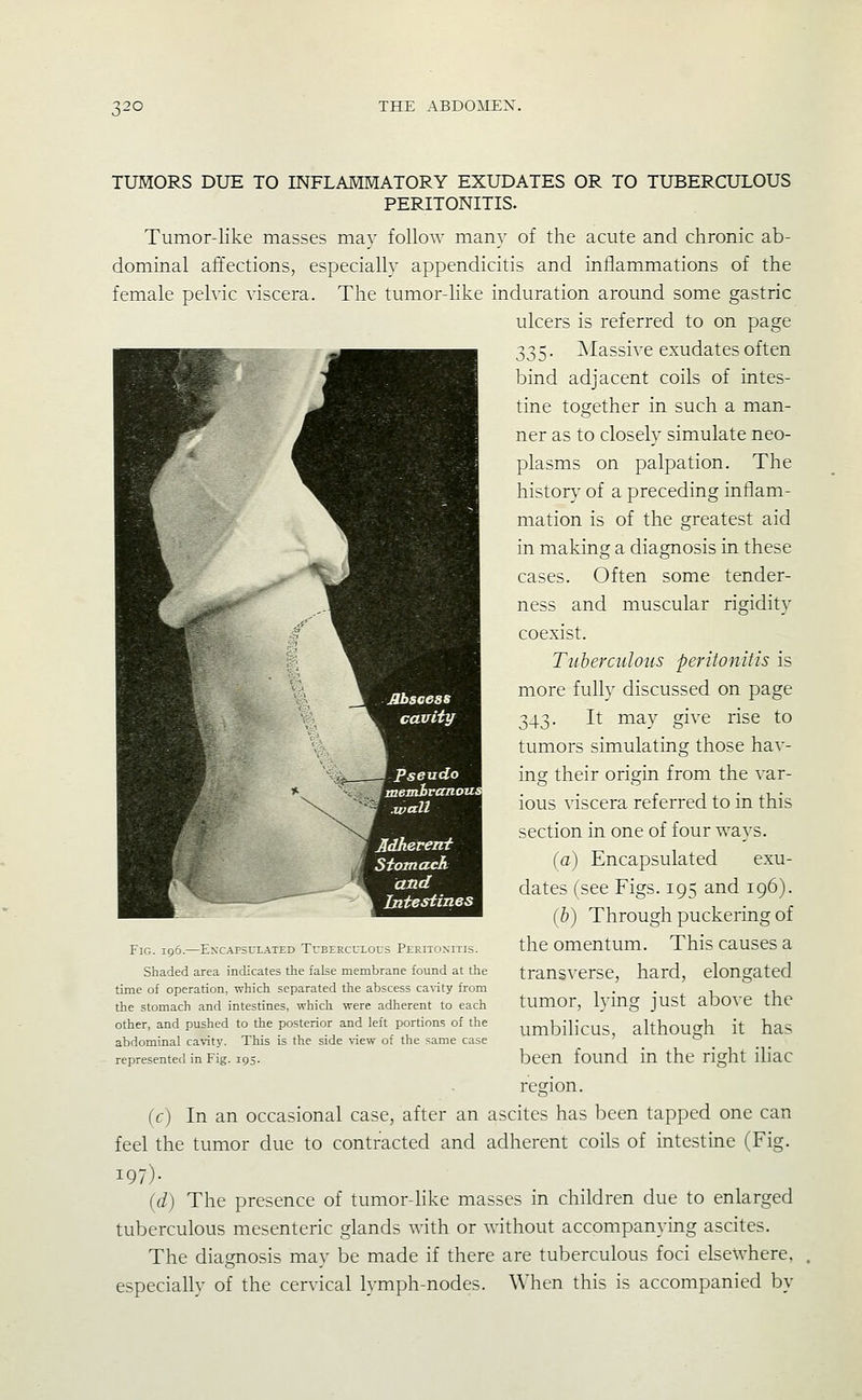 TUMORS DUE TO INFLAMMATORY EXUDATES OR TO TUBERCULOUS PERITONITIS. Tumor-like masses may follow many of the acute and chronic ab- dominal affections, especially appendicitis and inflammations of the female pelvic viscera. The tumor-like induration around some gastric ulcers is referred to on page 335. Massive exudates often bind adjacent coils of intes- tine together in such a man- ner as to closely simulate neo- plasms on palpation. The history of a preceding inflam- mation is of the greatest aid in making a diagnosis in these cases. Often some tender- ness and muscular rigidity coexist. Tuberculous peritonitis is more fully discussed on page 343. It may give rise to tumors simulating those bav- ins: their origin from the var- ious viscera referred to in this section in one of four ways. (a) Encapsulated exu- dates (see Figs. 195 and 196). (&) Through puckering of the omentum. This causes a transverse, hard, elongated tumor, lying just above the umbilicus, although it has been found in the right iliac region. (c) In an occasional case, after an ascites has been tapped one can feel the tumor due to contracted and adherent coils of intestine (Fig. 197)- (d) The presence of tumor-like masses in children due to enlarged tuberculous mesenteric glands with or without accompanying ascites. The diagnosis may be made if there are tuberculous foci elsewhere, especially of the cervical lymph-nodes. When this is accompanied by Fig. 196.—Enxapsulated TuBERCuLors Peritonitis. Shaded area indicates the false membrane found at the time of operation, which separated the abscess ca\Tty from the stomach and intestines, which were adherent to each other, and pushed to the posterior and left portions of the abdominal cavity. This is the side view of the same case represented in Fig. 195.