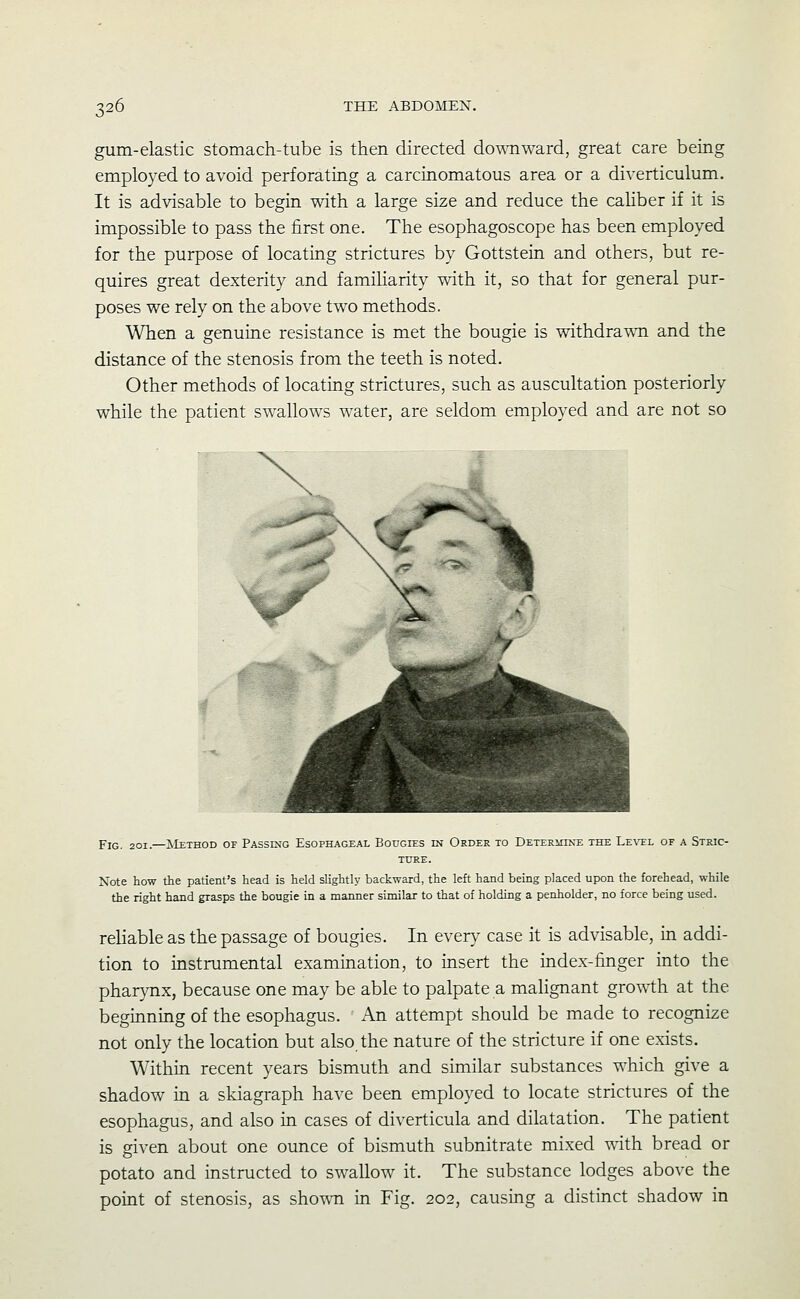 gum-elastic stomach-tube is then directed downward, great care being employed to avoid perforating a carcinomatous area or a diverticulum. It is advisable to begin Vvdth a large size and reduce the caHber if it is impossible to pass the first one. The esophagoscope has been employed for the purpose of locating strictures by Gottstein and others, but re- quires great dexterity and famiharity with it, so that for general pur- poses we rely on the above two methods. When a genuine resistance is met the bougie is withdrawn and the distance of the stenosis from the teeth is noted. Other methods of locating strictures, such as auscultation posteriorly while the patient swallows water, are seldom employed and are not so Fig. 201.—Method of PAssmo Esophageal Bougies in Order to DETERiONE the Le\'el of a Stric- ture. Note how the patient's head is held slightly backward, the left hand being placed upon the forehead, while the right hand grasps the bougie in a manner similar to that of holding a penholder, no force being used. reliable as the passage of bougies. In every case it is advisable, in addi- tion to instrumental examination, to insert the index-finger into the pharynx, because one may be able to palpate a malignant growth at the beginning of the esophagus. An attempt should be made to recognize not only the location but also the nature of the stricture if one exists. Within recent years bismuth and similar substances which give a shadow in a skiagraph have been employed to locate strictures of the esophagus, and also in cases of diverticula and dilatation. The patient is given about one ounce of bismuth subnitrate mixed with bread or potato and instructed to swallow it. The substance lodges above the point of stenosis, as shoT\'n in Fig. 202, causing a distinct shadow in