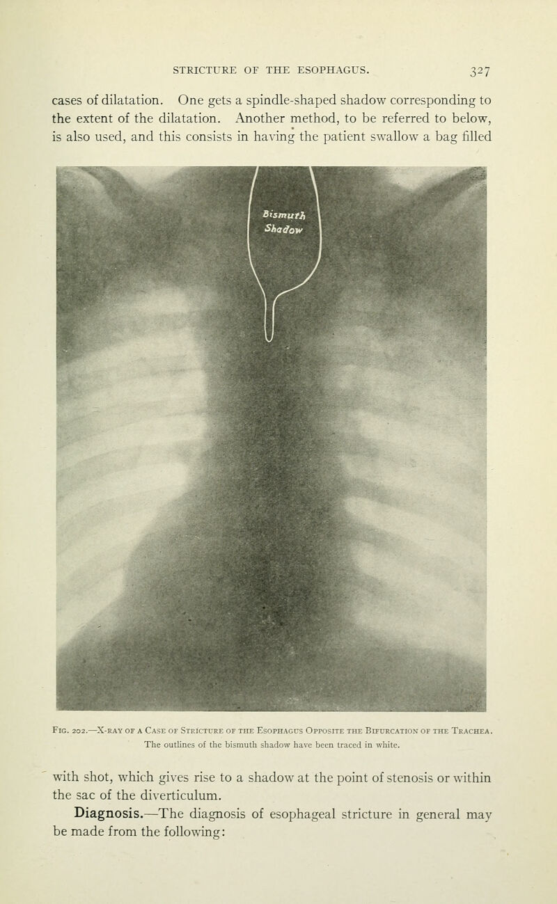 cases of dilatation. One gets a spindle-shaped shadow corresponding to the extent of the dilatation. Another method, to be referred to below, is also used, and this consists in having the patient swallow a bag filled Fig. 202.—^X-RAY OF a Case of Stp.icture of the Esophagus Opposite the Bifurcation of the Trachea. The outlines of the bismuth shadow have been traced in white. with shot, which gives rise to a shadow at the point of stenosis or within the sac of the diverticulum. Diagnosis.—The diagnosis of esophageal stricture in general may- be made from the following: