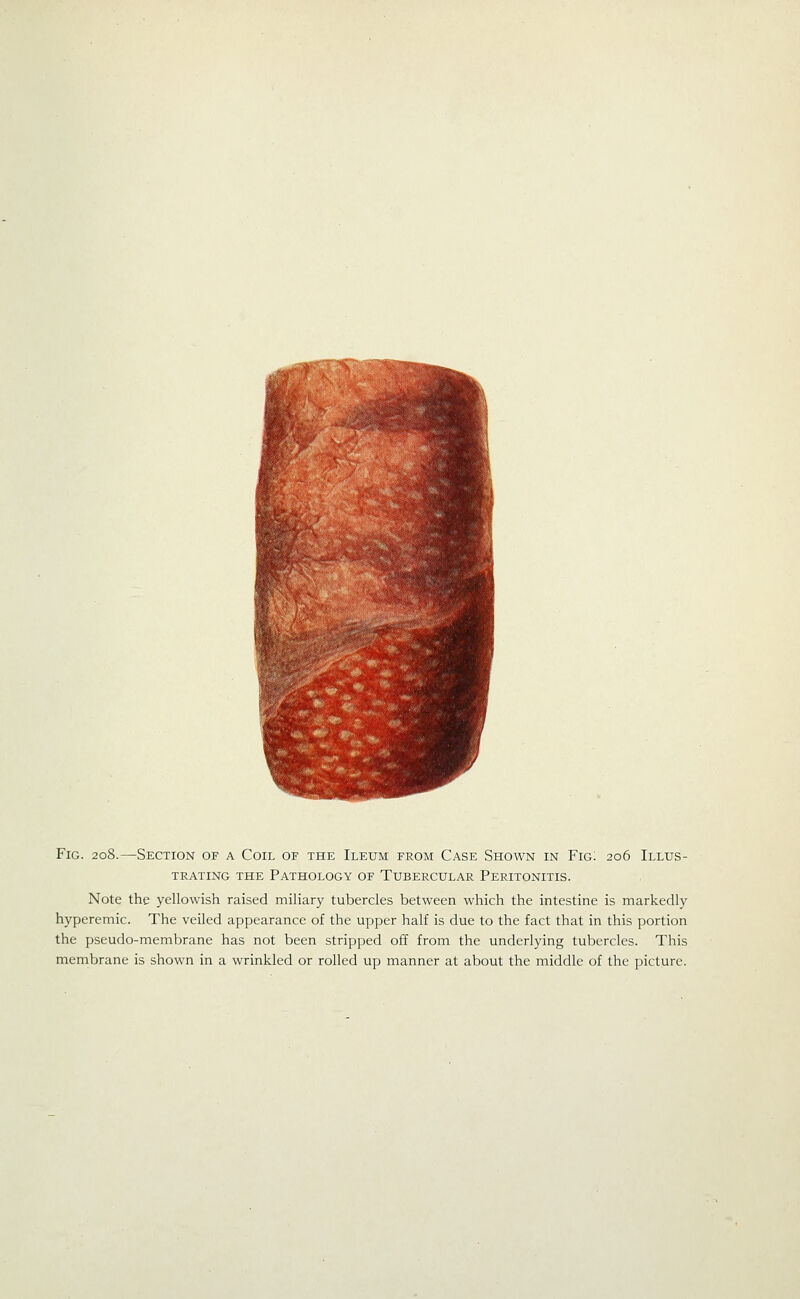 Fig. 208.—Section of a Coil of the Ileum from Case Shown in Fig; 206 Illus- trating THE Pathology of Tubercular Peritonitis. Note the yellowish raised miliary tubercles between which the intestine is markedly hyperemic. The veiled appearance of the upper half is due to the fact that in this portion the pseudo-membrane has not been stripped off from the underlying tubercles. This membrane is shown in a wrinkled or rolled up manner at about the middle of the picture.