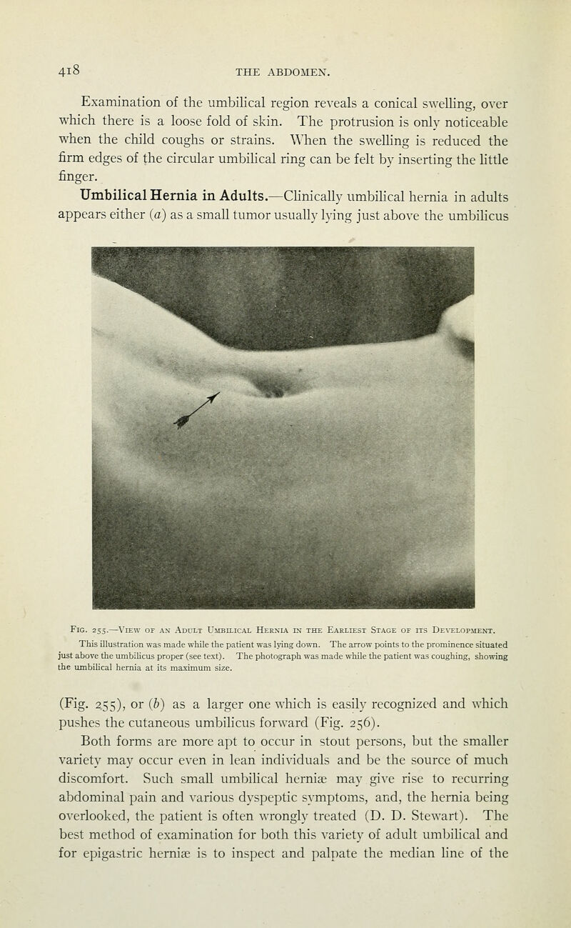 Examination of the umbilical region reveals a conical swelling, over which there is a loose fold of skin. The protrusion is only noticeable when the child coughs or strains. When the swelhng is reduced the firm edges of the circular umbihcal ring can be felt by inserting the httle finger. Umbilical Hernia in Adults.—Chnically umbihcal hernia in adults appears either (a) as a small tumor usually lying just above the umbihcus ^^/M Fig. 255.—View of an Adult Umbilical Hernla in the Earliest Stage of its DEVELopiiENT. This illustration was made while the patient was lying down. The arrow points to the prominence situated just above the umbihcus proper (see text). The photograph was made while the patient was coughing, shomng the umbihcal hernia at its maximum size. (Fig. 255), or (5) as a larger one wliich is easily recognized and which pushes the cutaneous umbilicus forward (Fig. 256). Both forms are more apt to occur in stout persons, but the smaller variety may occur even in lean individuals and be the source of much discomfort. Such small umbilical herniae may give rise to recurring abdominal pain and various dyspeptic symptoms, and, the hernia being overlooked, the patient is often wrongly treated (D. D. Stewart). The best method of examination for both this variety of adult umbilical and for epigastric herniae is to inspect and palpate the median line of the