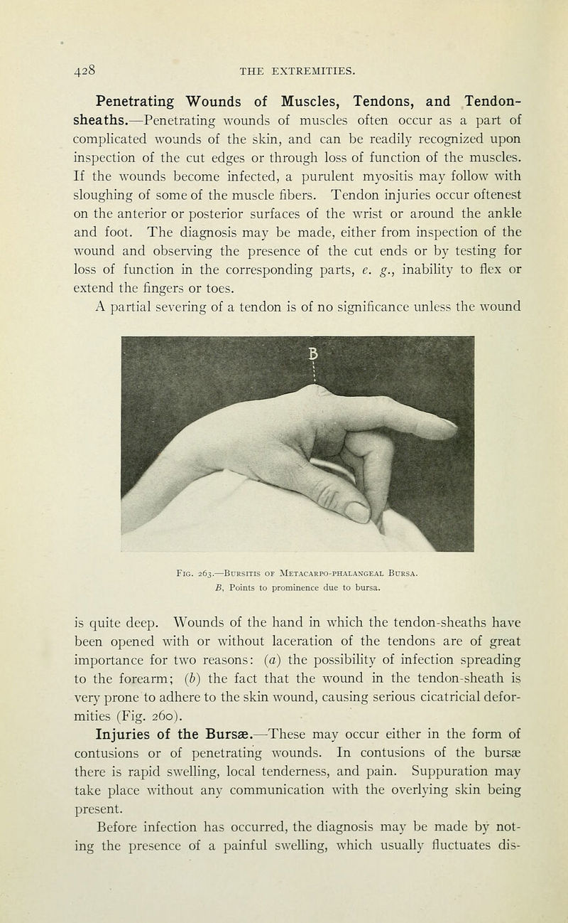 Penetrating Wounds of Muscles, Tendons, and Tendon- sheaths.—Penetrating wounds of muscles often occur as a part of complicated wounds of the skin, and can be readily recognized upon inspection of tlie cut edges or through loss of function of the muscles. If the wounds become infected, a purulent myositis may follow with sloughing of some of the muscle fibers. Tendon injuries occur oftenest on the anterior or posterior surfaces of the wrist or around the ankle and foot. The diagnosis may be made, either from inspection of the wound and observing the presence of the cut ends or by testing for loss of function in the corresponding parts, e. g., inability to flex or extend the fingers or toes. A partial severing of a tendon is of no significance unless the wound Fig. 263.—Bursitis of Metacarpo-phalangeal Bursa. B, Points to prominence due to bursa. is quite deep. Wounds of the hand in which the tendon-sheaths have been opened with or without laceration of the tendons are of great importance for two reasons: (a) the possibihty of infection spreading to the forearm; (b) the fact that the wound in the tendon-sheath is very prone to adhere to the skin wound, causing serious cicatricial defor- mities (Fig. 260). Injuries of the Bursae.—These may occur either in the form of contusions or of penetrating wounds. In contusions of the bursae there is rapid swelhng, local tenderness, and pain. Suppuration may take place without any communication with the overlying skin being present. Before infection has occurred, the diagnosis may be made by not- ing the presence of a painful swelling, which usually fluctuates dis-